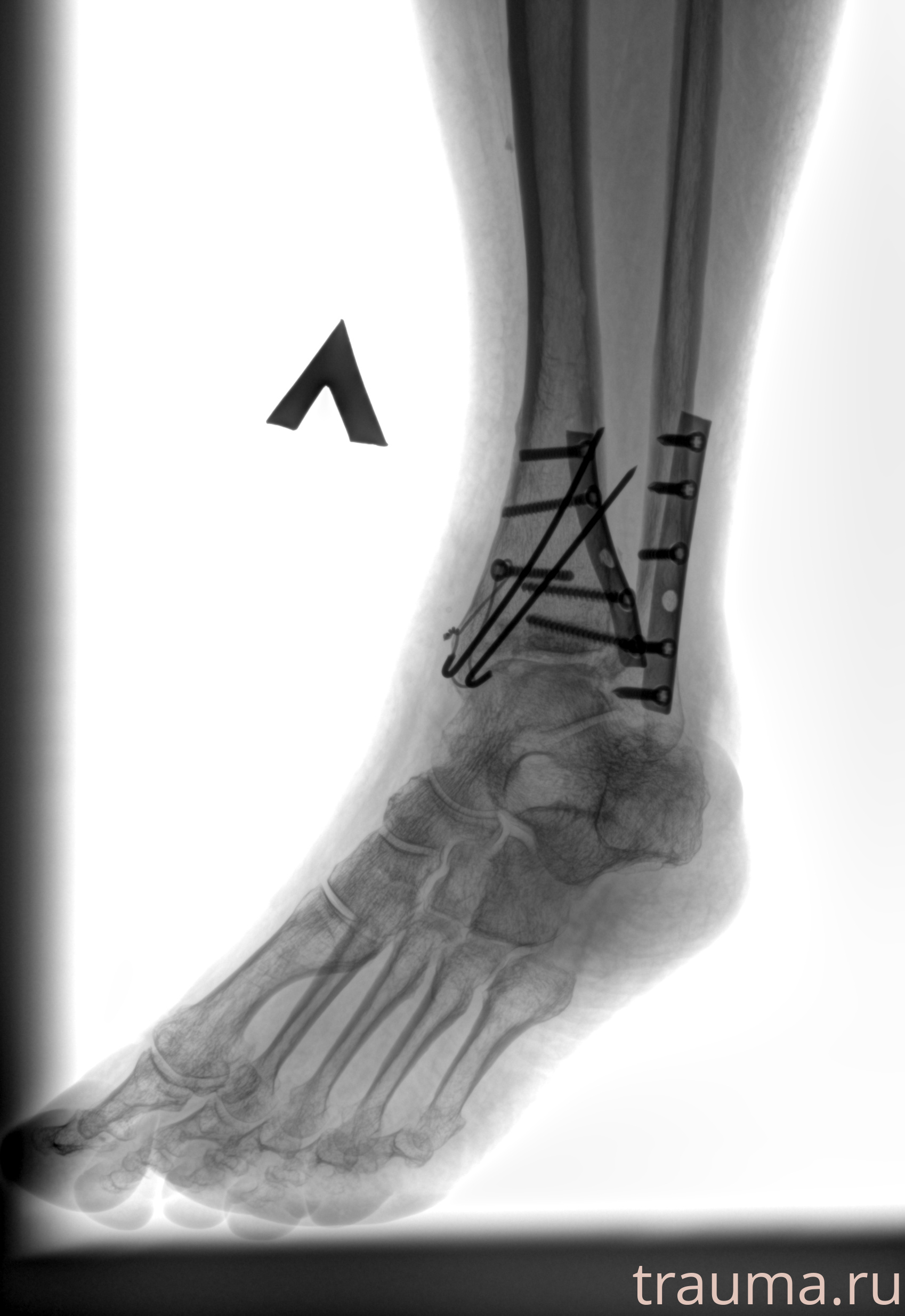 Рентген на дому: по вашему адресу приезжает врач-рентгенолог, травматолог-ортопед с мобильным рентгеновским аппаратом, проводит диагностику травмы или заболевания, делает необходимые рентгенограммы, дает рекомендации по дальнейшему лечению. Получить качественные снимки в домашних условиях возможно благодаря уникальной методике, разработанной МосРентген Центром для института  Склифосовского