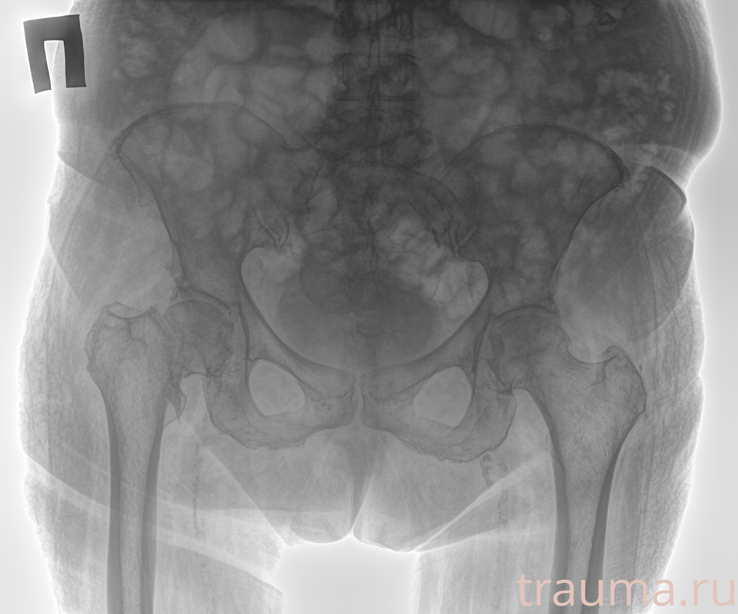 Рентген на дому: по вашему адресу приезжает врач-рентгенолог, травматолог-ортопед с мобильным рентгеновским аппаратом, проводит диагностику травмы или заболевания, делает необходимые рентгенограммы, дает рекомендации по дальнейшему лечению. Получить качественные снимки в домашних условиях возможно благодаря уникальной методике, разработанной МосРентген Центром для института  Склифосовского