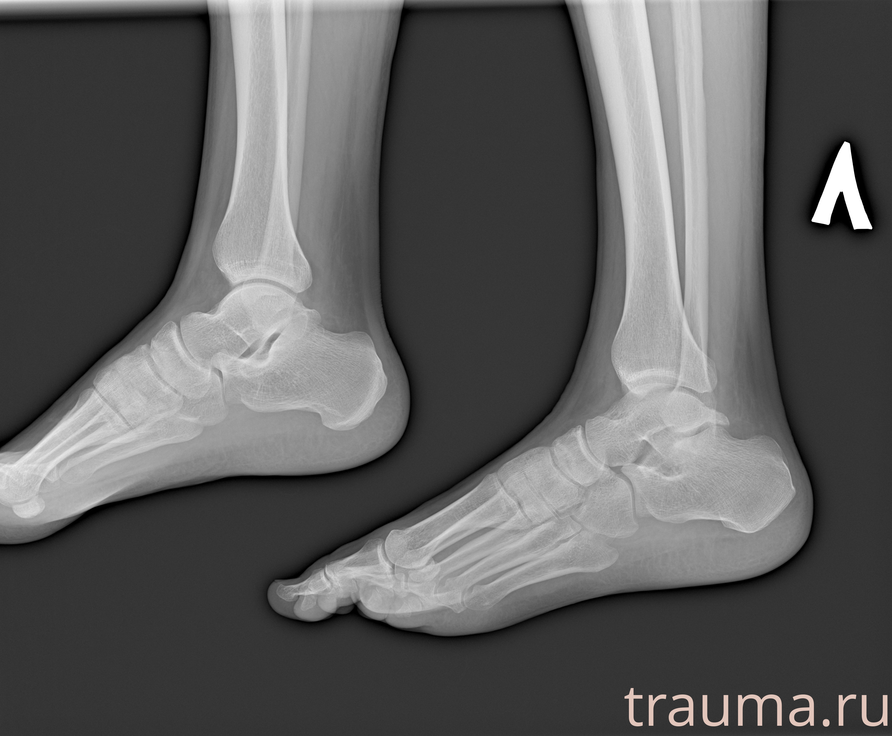 Рентген на дому: по вашему адресу приезжает врач-рентгенолог, травматолог-ортопед с мобильным рентгеновским аппаратом, проводит диагностику травмы или заболевания, делает необходимые рентгенограммы, дает рекомендации по дальнейшему лечению. Получить качественные снимки в домашних условиях возможно благодаря уникальной методике, разработанной МосРентген Центром для института  Склифосовского