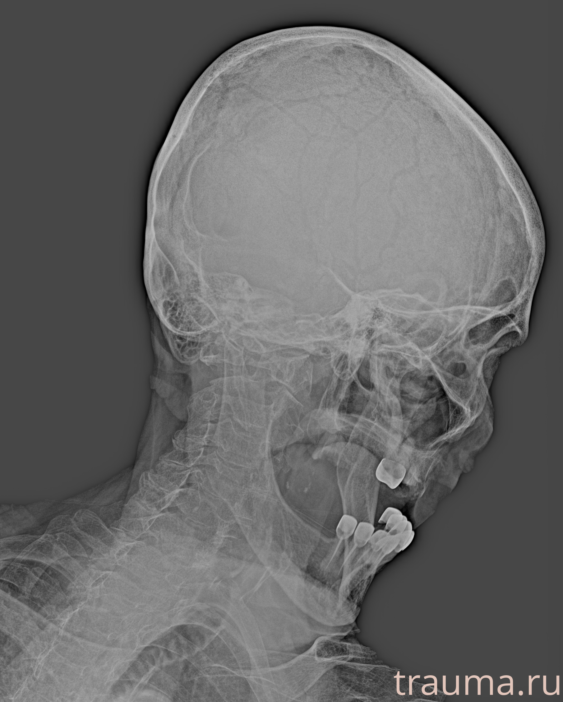 Рентген на дому: по вашему адресу приезжает врач-рентгенолог, травматолог-ортопед с мобильным рентгеновским аппаратом, проводит диагностику травмы или заболевания, делает необходимые рентгенограммы, дает рекомендации по дальнейшему лечению. Получить качественные снимки в домашних условиях возможно благодаря уникальной методике, разработанной МосРентген Центром для института  Склифосовского