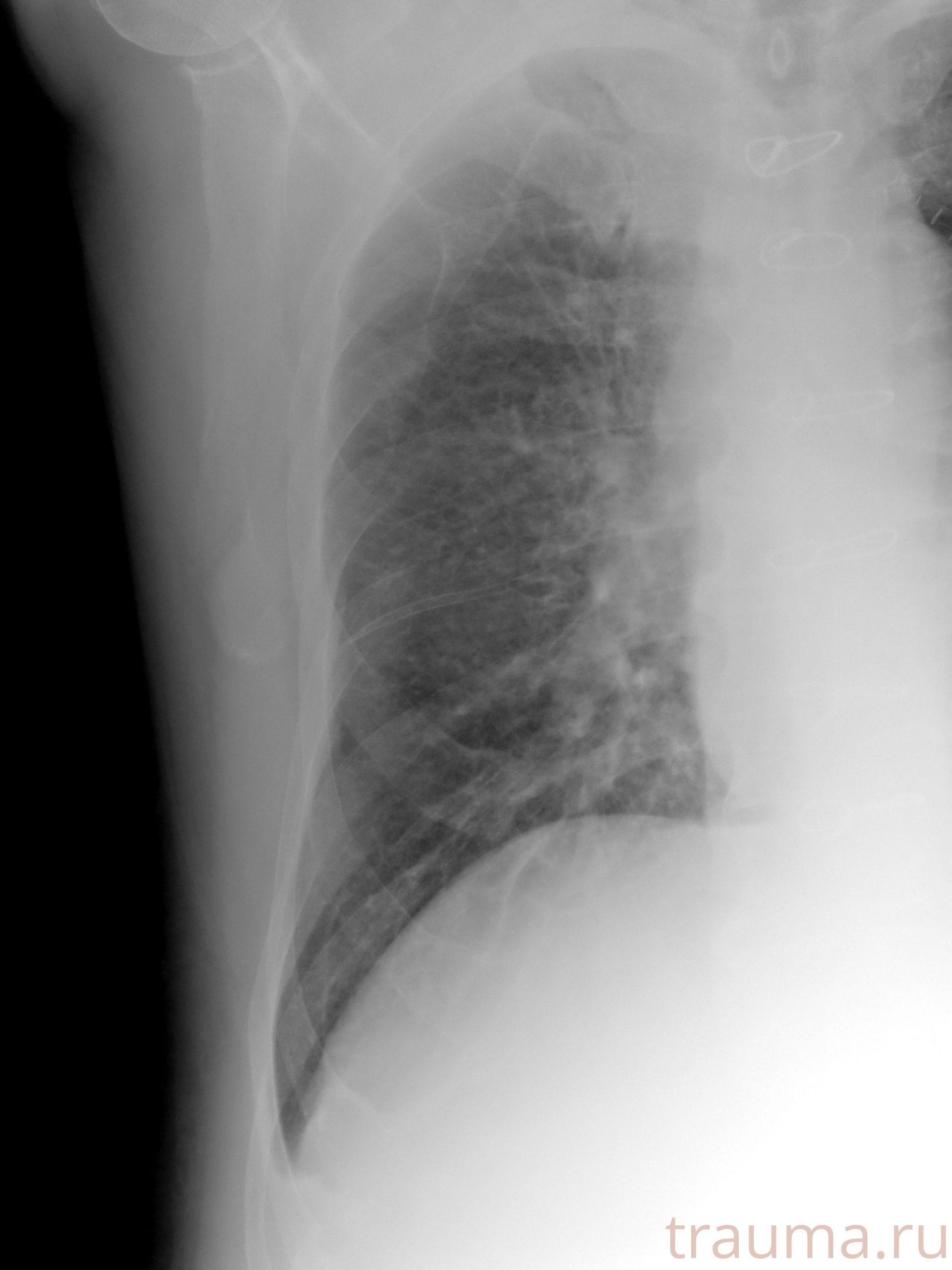 Рентген на дому: по вашему адресу приезжает врач-рентгенолог, травматолог-ортопед с мобильным рентгеновским аппаратом, проводит диагностику травмы или заболевания, делает необходимые рентгенограммы, дает рекомендации по дальнейшему лечению. Получить качественные снимки в домашних условиях возможно благодаря уникальной методике, разработанной МосРентген Центром для института  Склифосовского