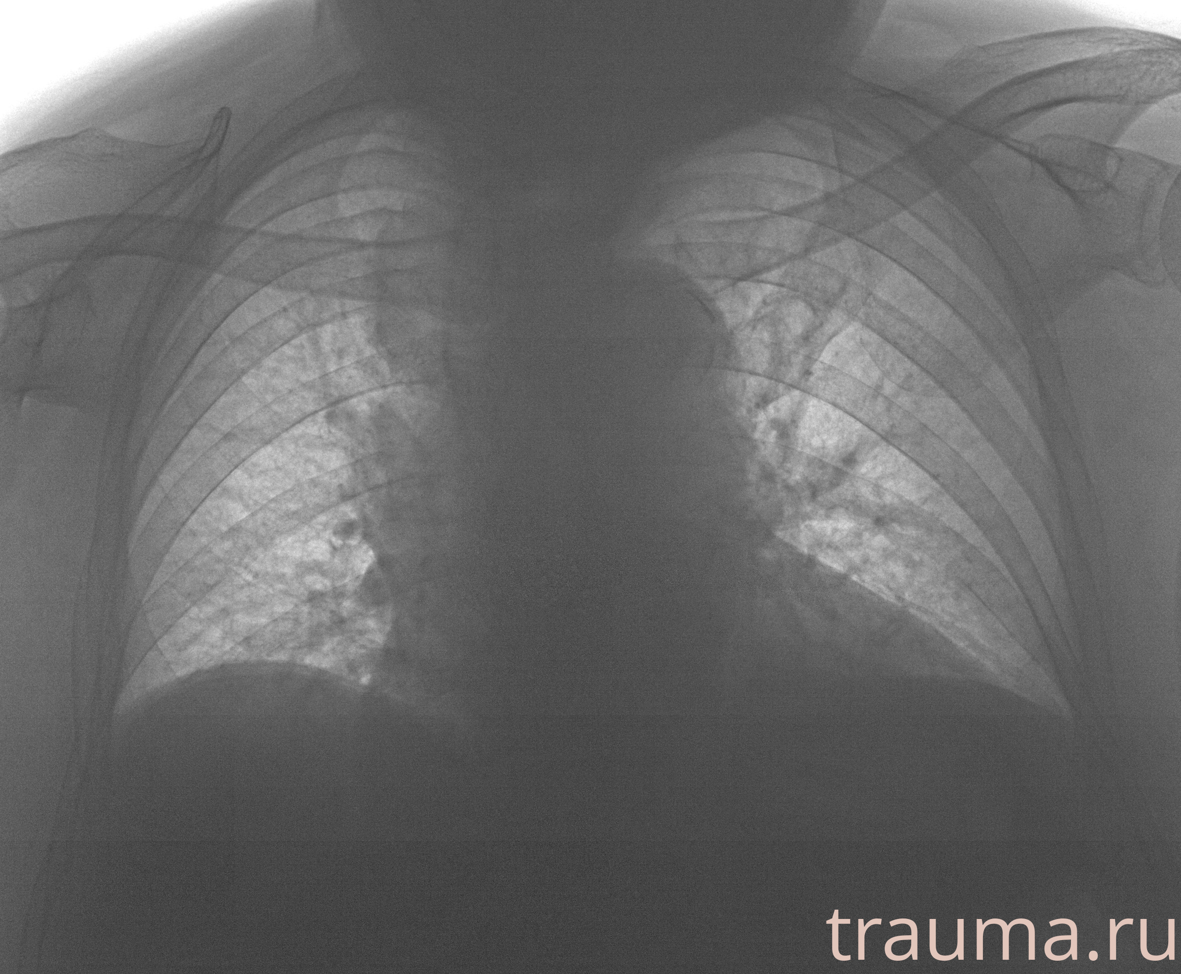 Рентген на дому: по вашему адресу приезжает врач-рентгенолог, травматолог-ортопед с мобильным рентгеновским аппаратом, проводит диагностику травмы или заболевания, делает необходимые рентгенограммы, дает рекомендации по дальнейшему лечению. Получить качественные снимки в домашних условиях возможно благодаря уникальной методике, разработанной МосРентген Центром для института  Склифосовского