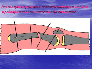 Диагностика воспалительного процесса при переломах длинных трубчатых костей Диагностика воспалительного процесса при переломах длинных трубчатых костей