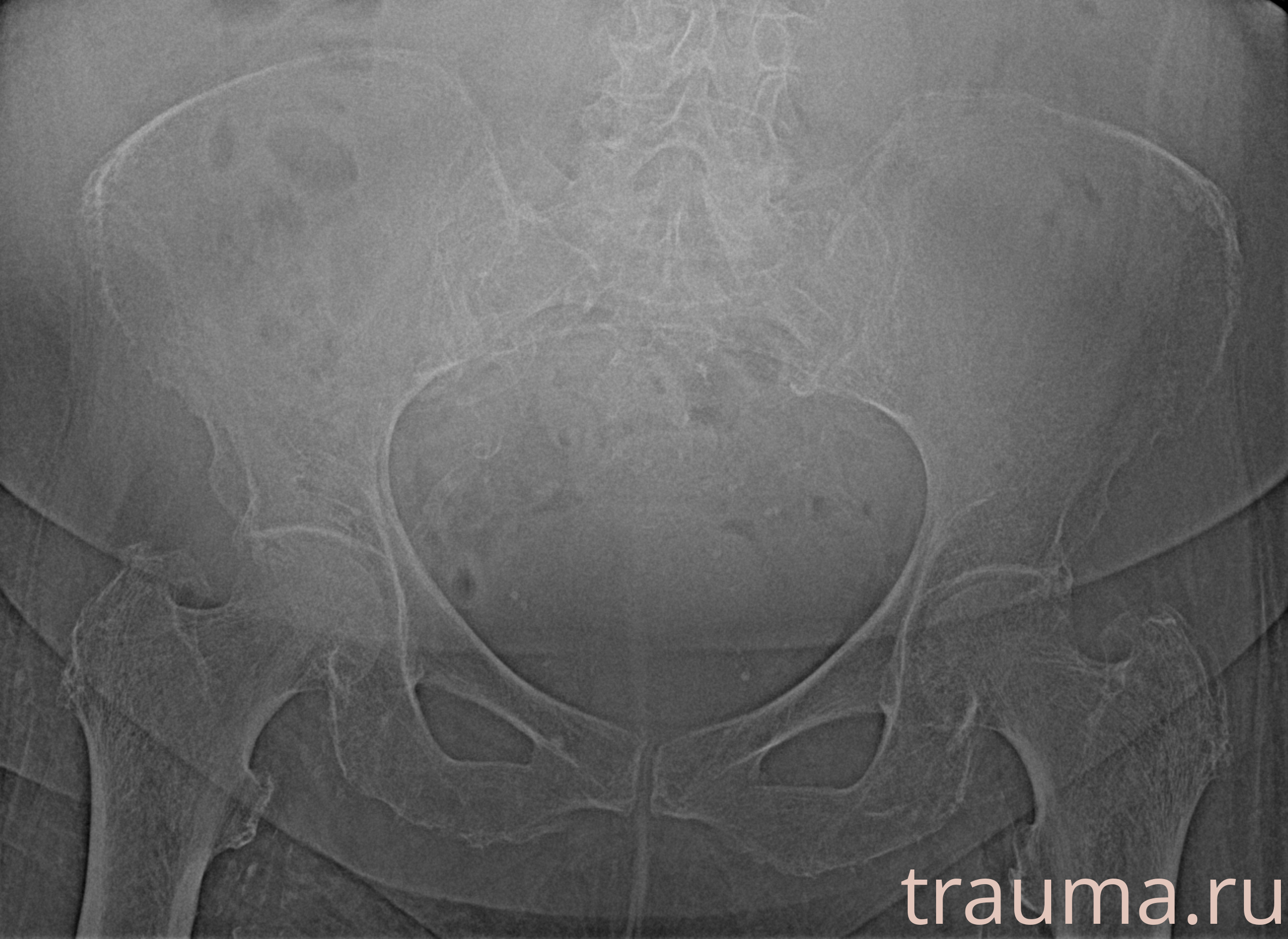 Рентген на дому: по вашему адресу приезжает врач-рентгенолог, травматолог-ортопед с мобильным рентгеновским аппаратом, проводит диагностику травмы или заболевания, делает необходимые рентгенограммы, дает рекомендации по дальнейшему лечению. Получить качественные снимки в домашних условиях возможно благодаря уникальной методике, разработанной МосРентген Центром для института  Склифосовского