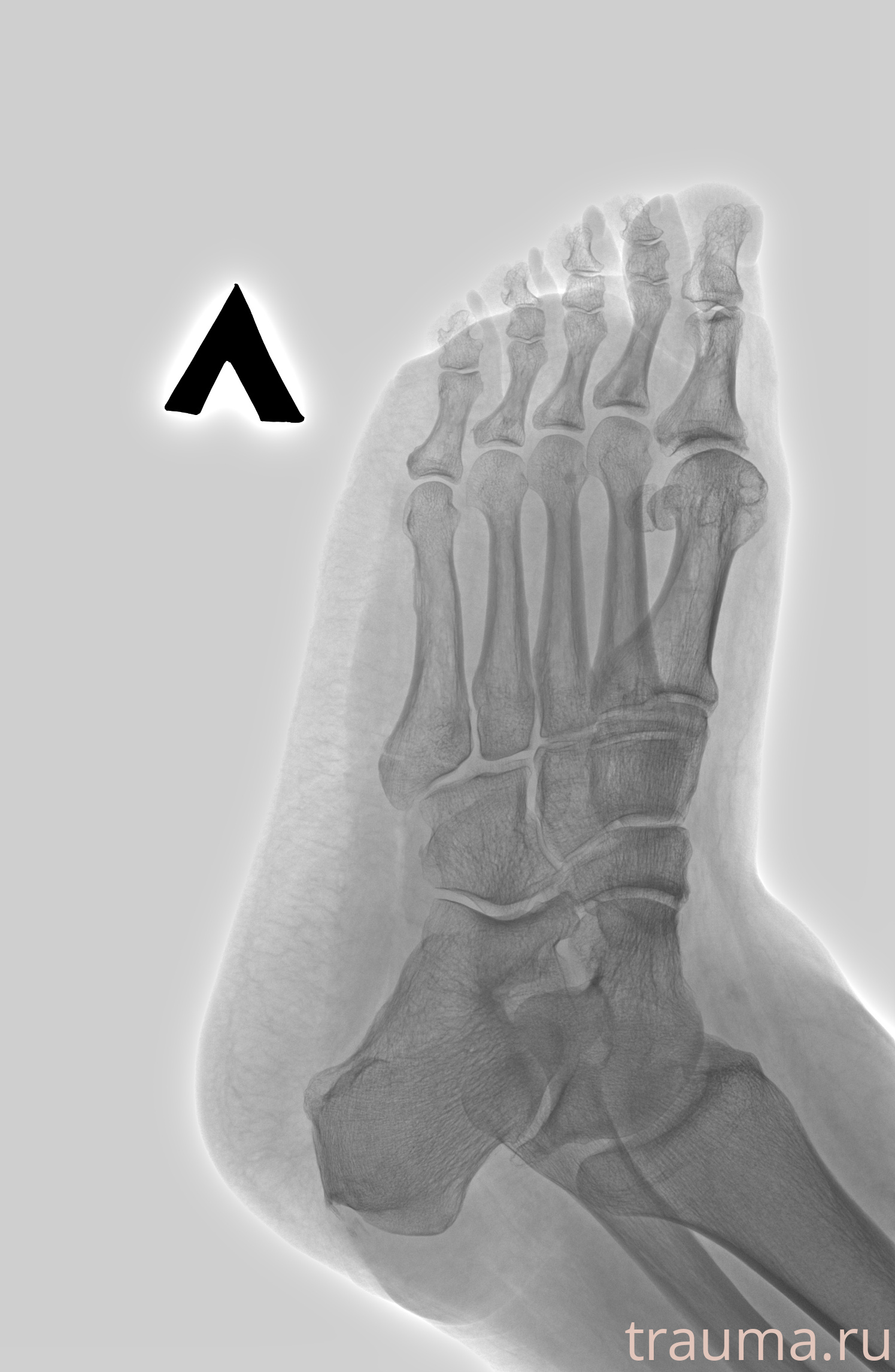 Рентген на дому: по вашему адресу приезжает врач-рентгенолог, травматолог-ортопед с мобильным рентгеновским аппаратом, проводит диагностику травмы или заболевания, делает необходимые рентгенограммы, дает рекомендации по дальнейшему лечению. Получить качественные снимки в домашних условиях возможно благодаря уникальной методике, разработанной МосРентген Центром для института  Склифосовского