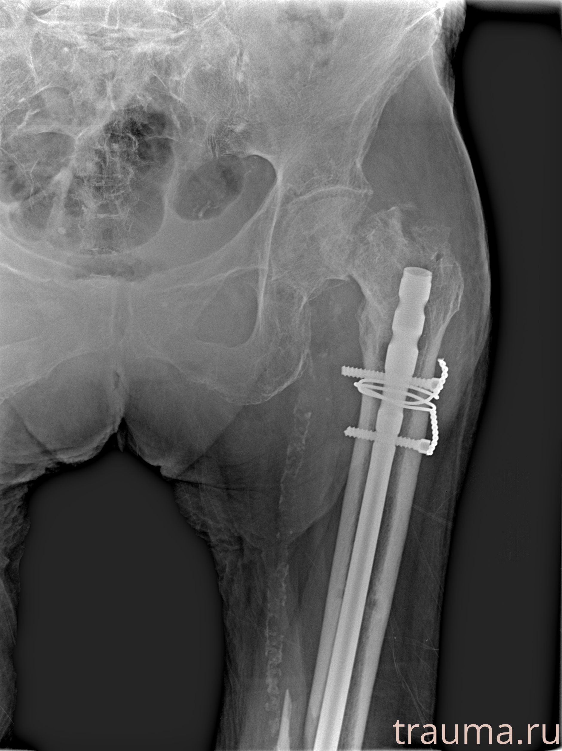 Рентген на дому: по вашему адресу приезжает врач-рентгенолог, травматолог-ортопед с мобильным рентгеновским аппаратом, проводит диагностику травмы или заболевания, делает необходимые рентгенограммы, дает рекомендации по дальнейшему лечению. Получить качественные снимки в домашних условиях возможно благодаря уникальной методике, разработанной МосРентген Центром для института  Склифосовского