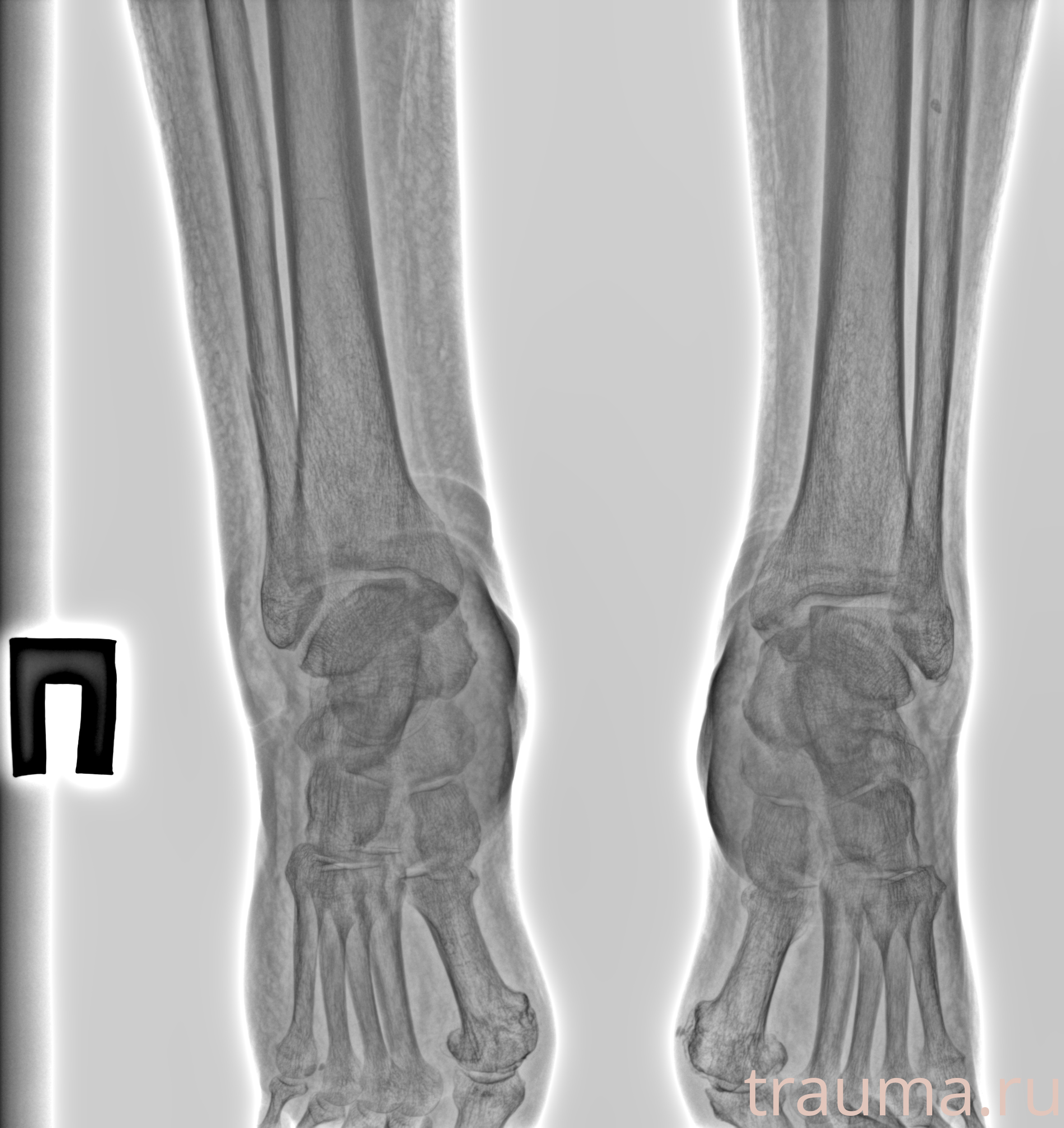 Рентген на дому: по вашему адресу приезжает врач-рентгенолог, травматолог-ортопед с мобильным рентгеновским аппаратом, проводит диагностику травмы или заболевания, делает необходимые рентгенограммы, дает рекомендации по дальнейшему лечению. Получить качественные снимки в домашних условиях возможно благодаря уникальной методике, разработанной МосРентген Центром для института  Склифосовского