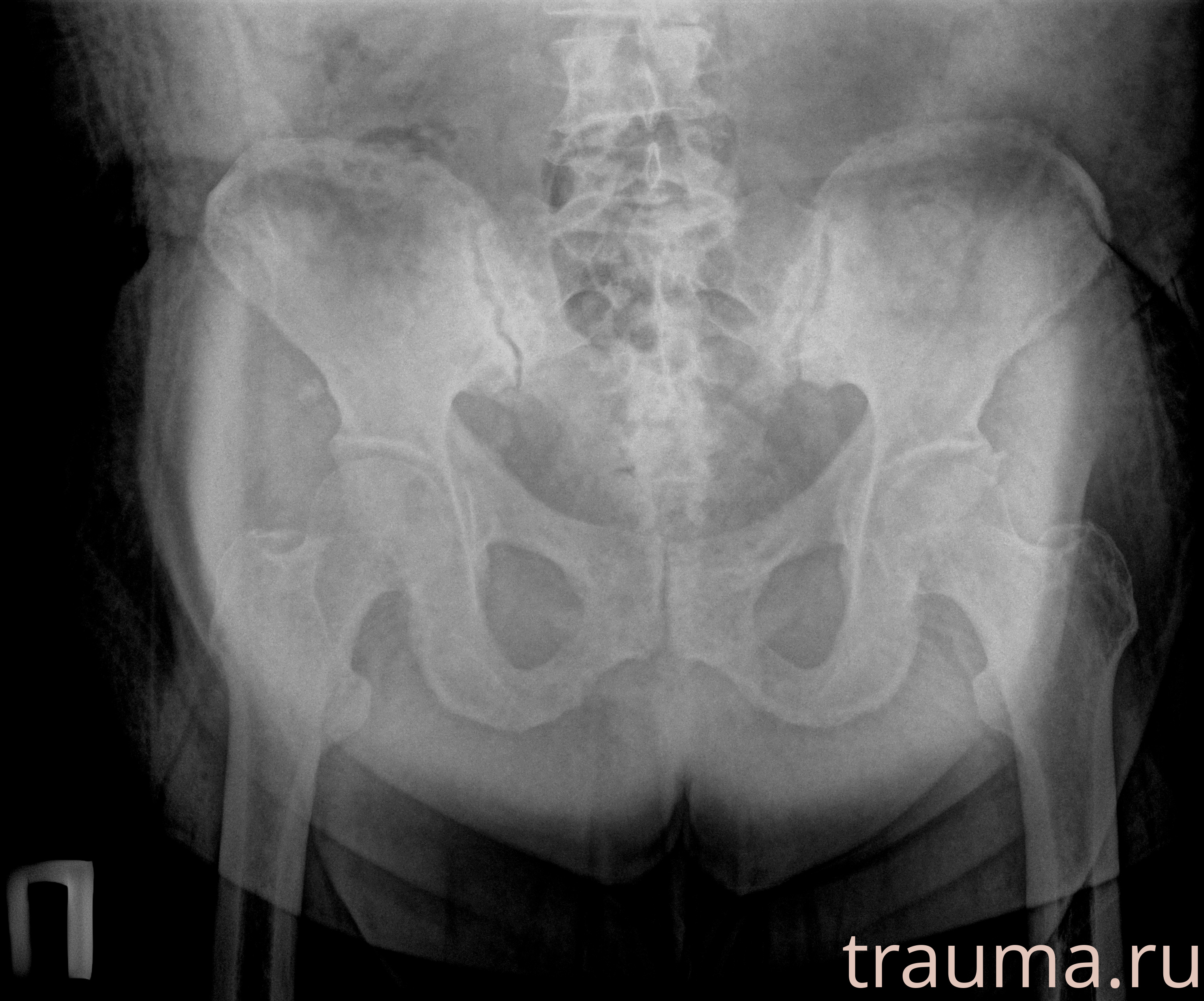 Рентген на дому: по вашему адресу приезжает врач-рентгенолог, травматолог-ортопед с мобильным рентгеновским аппаратом, проводит диагностику травмы или заболевания, делает необходимые рентгенограммы, дает рекомендации по дальнейшему лечению. Получить качественные снимки в домашних условиях возможно благодаря уникальной методике, разработанной МосРентген Центром для института  Склифосовского