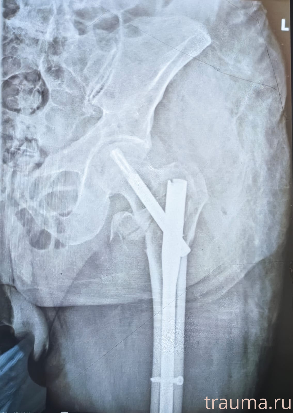 Рентген на дому: по вашему адресу приезжает врач-рентгенолог, травматолог-ортопед с мобильным рентгеновским аппаратом, проводит диагностику травмы или заболевания, делает необходимые рентгенограммы, дает рекомендации по дальнейшему лечению. Получить качественные снимки в домашних условиях возможно благодаря уникальной методике, разработанной МосРентген Центром для института  Склифосовского