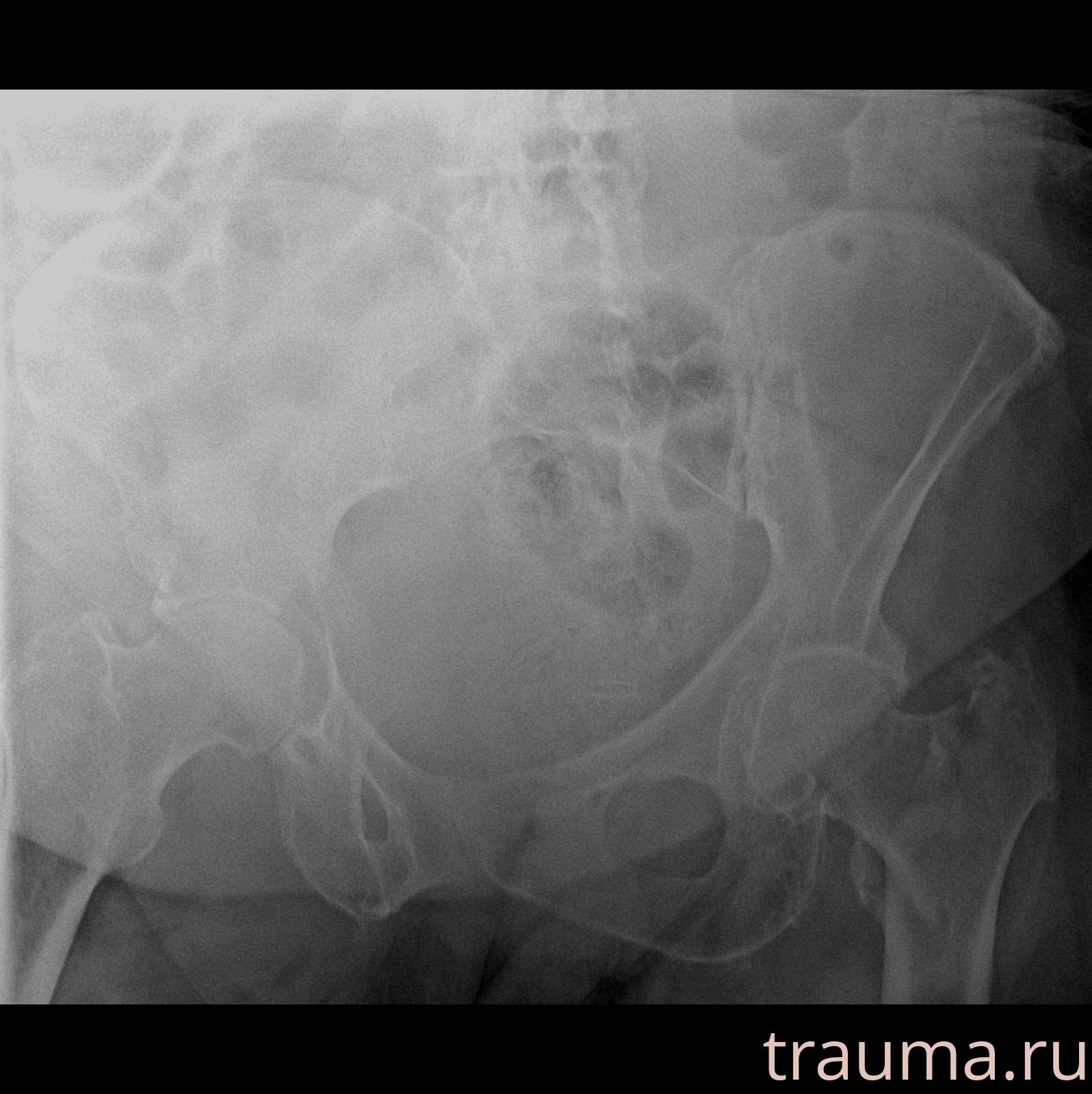 Рентген на дому: по вашему адресу приезжает врач-рентгенолог, травматолог-ортопед с мобильным рентгеновским аппаратом, проводит диагностику травмы или заболевания, делает необходимые рентгенограммы, дает рекомендации по дальнейшему лечению. Получить качественные снимки в домашних условиях возможно благодаря уникальной методике, разработанной МосРентген Центром для института  Склифосовского