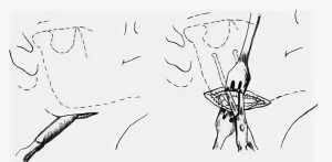 Хроническая тканевая гипертензия у пациентов, оперированных по поводу межмышечных флегмон верхней конечности (диагностика, лечение, профилактика)