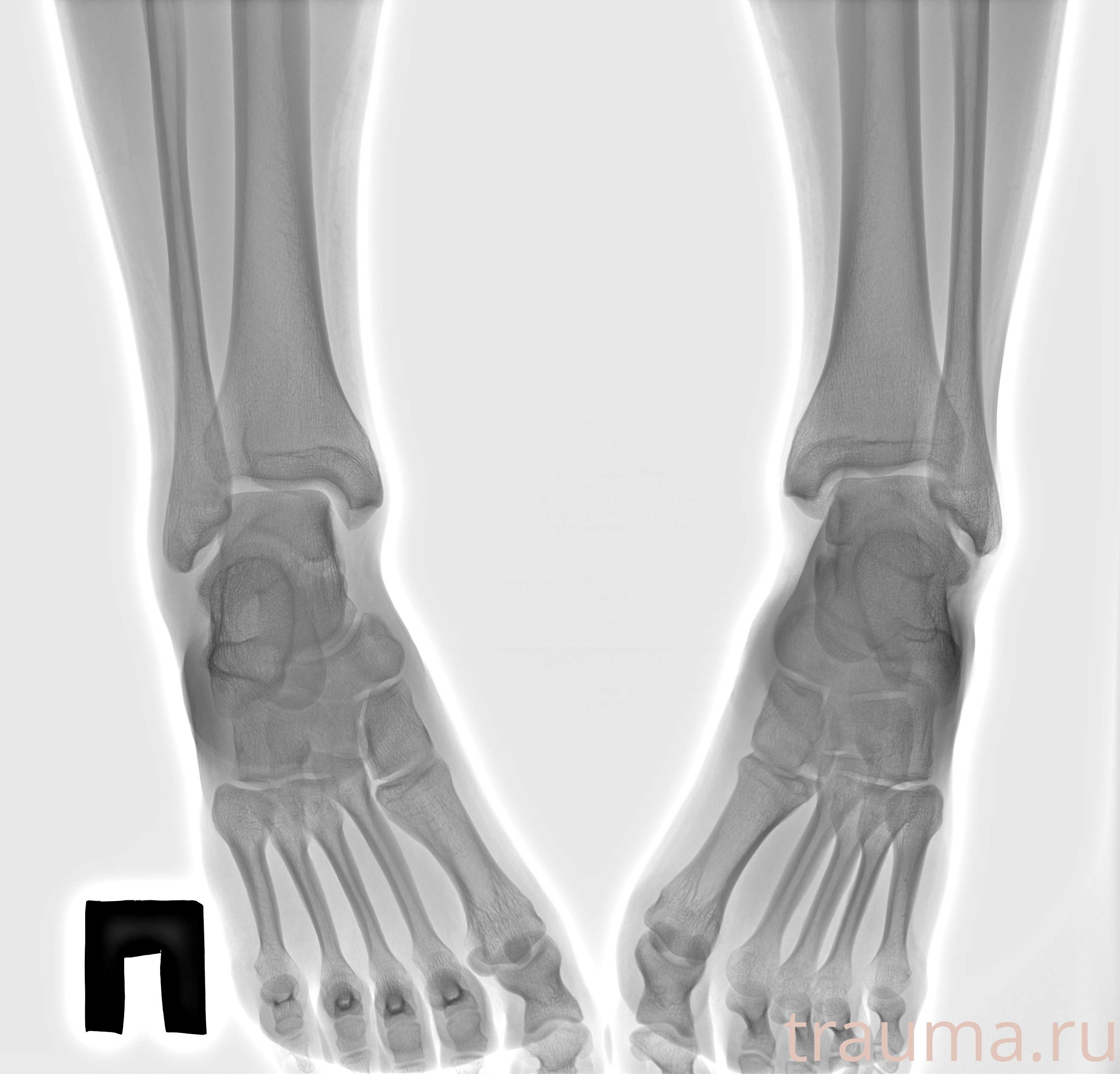 Рентген на дому: по вашему адресу приезжает врач-рентгенолог, травматолог-ортопед с мобильным рентгеновским аппаратом, проводит диагностику травмы или заболевания, делает необходимые рентгенограммы, дает рекомендации по дальнейшему лечению. Получить качественные снимки в домашних условиях возможно благодаря уникальной методике, разработанной МосРентген Центром для института  Склифосовского