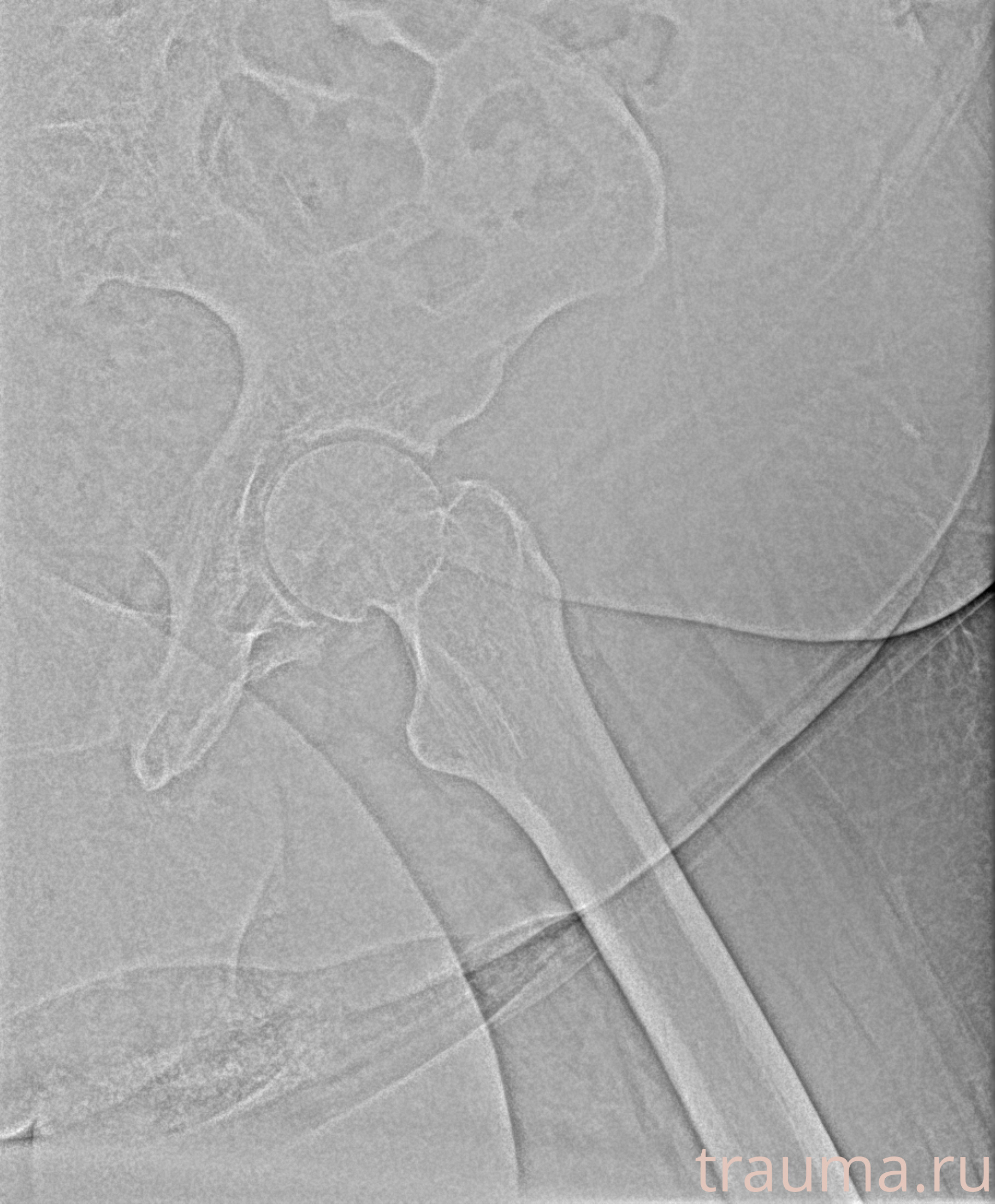 Рентген на дому: по вашему адресу приезжает врач-рентгенолог, травматолог-ортопед с мобильным рентгеновским аппаратом, проводит диагностику травмы или заболевания, делает необходимые рентгенограммы, дает рекомендации по дальнейшему лечению. Получить качественные снимки в домашних условиях возможно благодаря уникальной методике, разработанной МосРентген Центром для института  Склифосовского