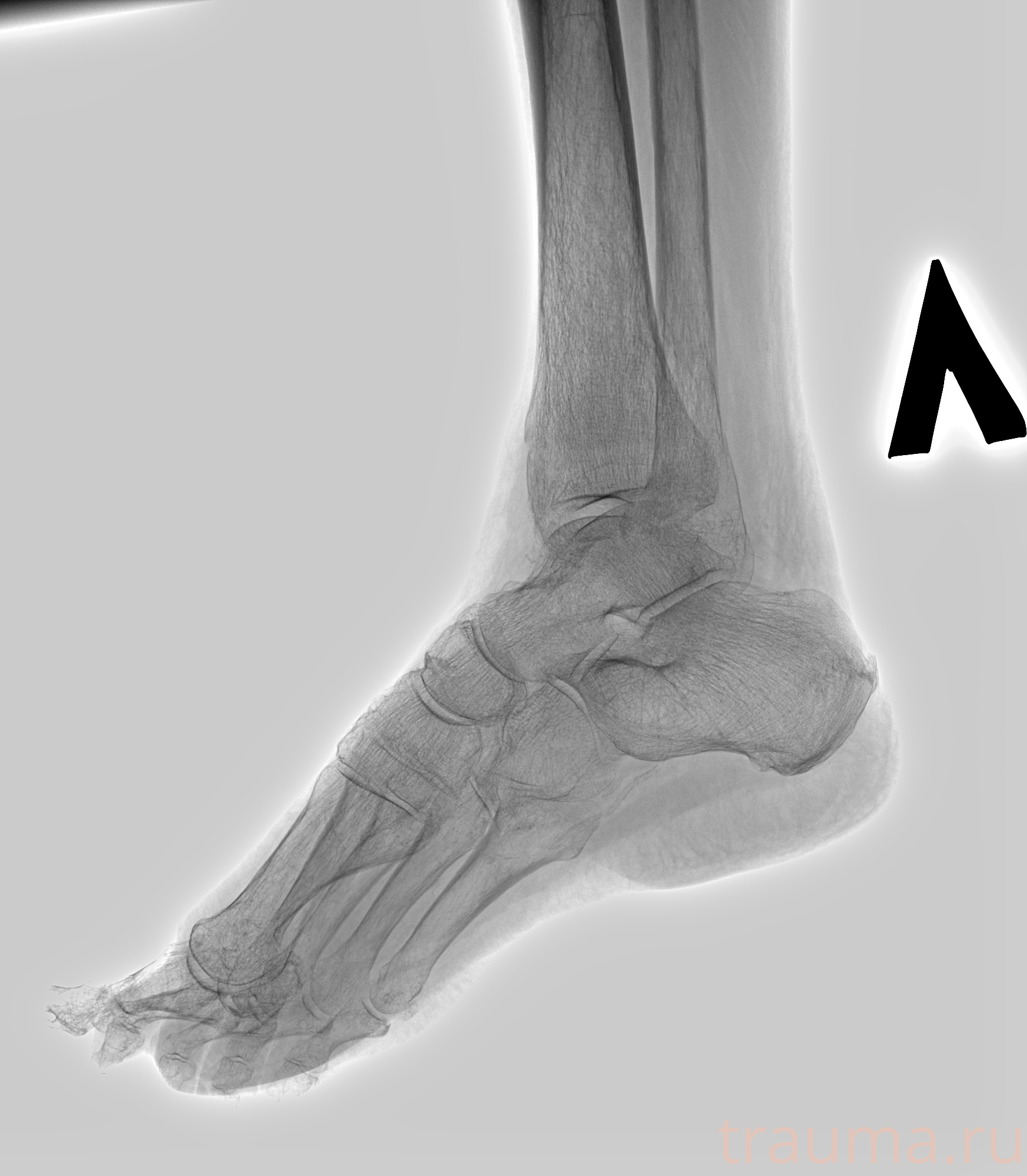 Рентген на дому: по вашему адресу приезжает врач-рентгенолог, травматолог-ортопед с мобильным рентгеновским аппаратом, проводит диагностику травмы или заболевания, делает необходимые рентгенограммы, дает рекомендации по дальнейшему лечению. Получить качественные снимки в домашних условиях возможно благодаря уникальной методике, разработанной МосРентген Центром для института  Склифосовского