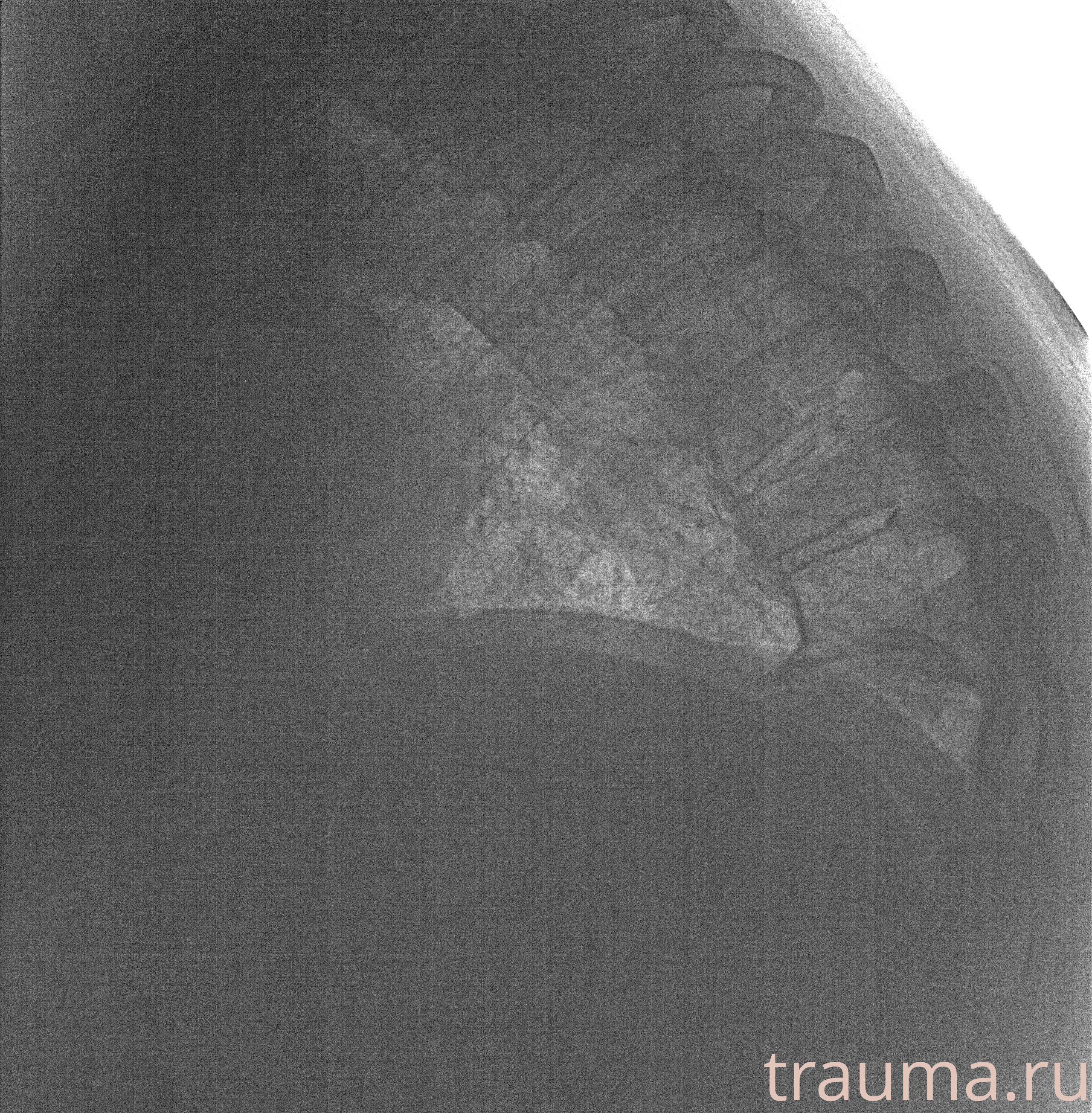 Рентген на дому: по вашему адресу приезжает врач-рентгенолог, травматолог-ортопед с мобильным рентгеновским аппаратом, проводит диагностику травмы или заболевания, делает необходимые рентгенограммы, дает рекомендации по дальнейшему лечению. Получить качественные снимки в домашних условиях возможно благодаря уникальной методике, разработанной МосРентген Центром для института  Склифосовского