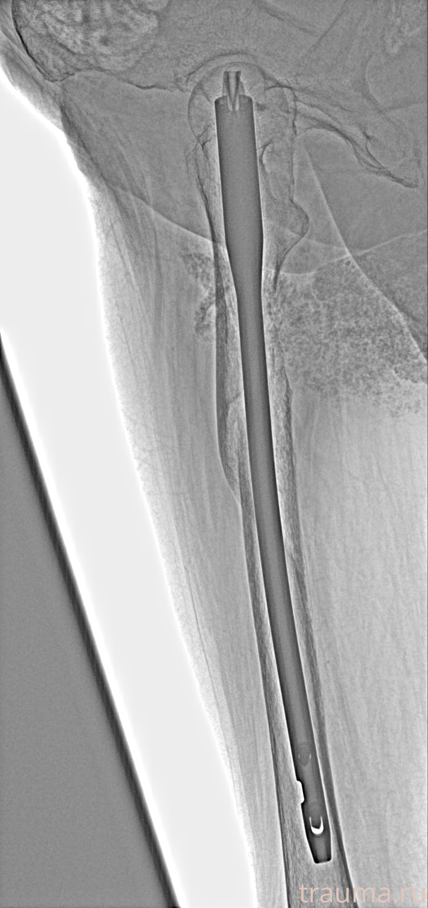 Рентген на дому: по вашему адресу приезжает врач-рентгенолог, травматолог-ортопед с мобильным рентгеновским аппаратом, проводит диагностику травмы или заболевания, делает необходимые рентгенограммы, дает рекомендации по дальнейшему лечению. Получить качественные снимки в домашних условиях возможно благодаря уникальной методике, разработанной МосРентген Центром для института  Склифосовского