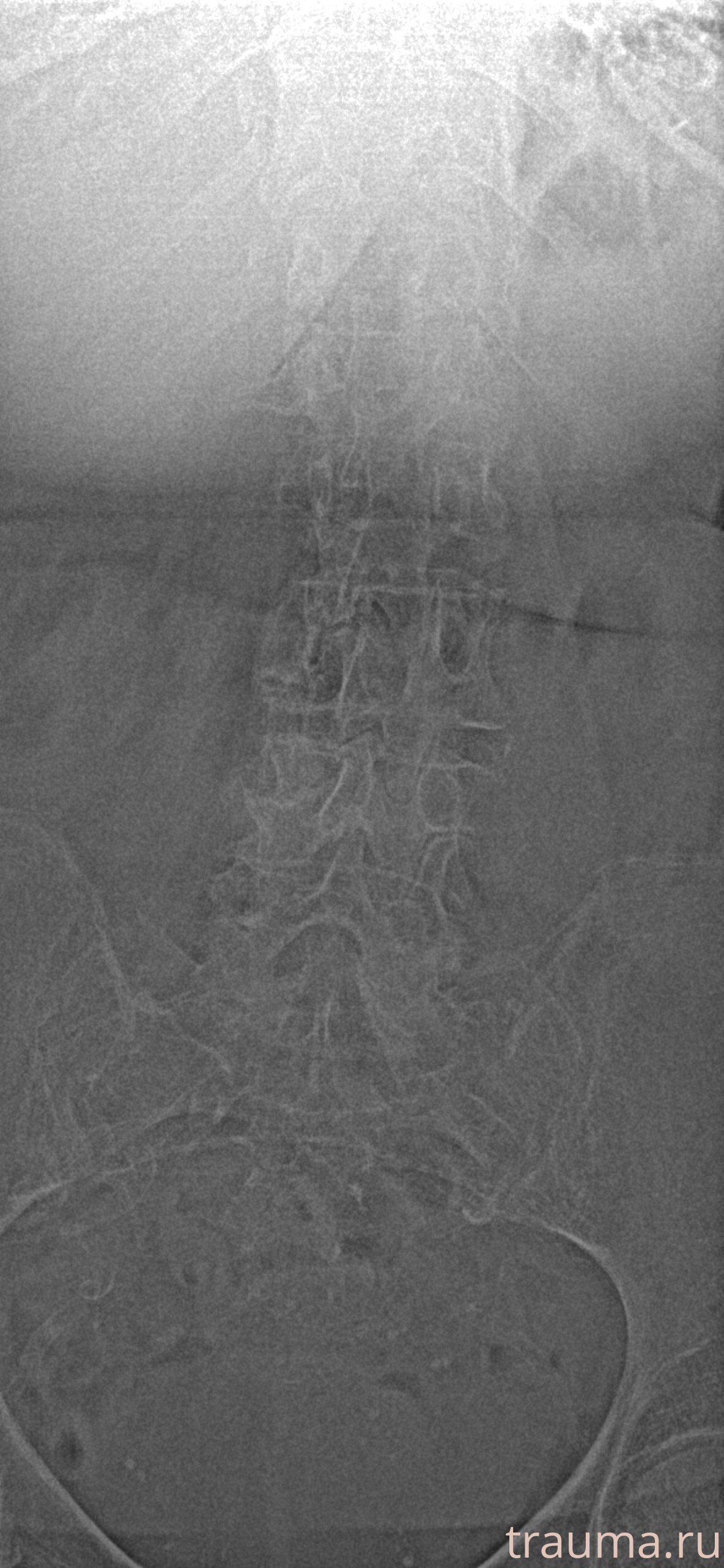 Рентген на дому: по вашему адресу приезжает врач-рентгенолог, травматолог-ортопед с мобильным рентгеновским аппаратом, проводит диагностику травмы или заболевания, делает необходимые рентгенограммы, дает рекомендации по дальнейшему лечению. Получить качественные снимки в домашних условиях возможно благодаря уникальной методике, разработанной МосРентген Центром для института  Склифосовского