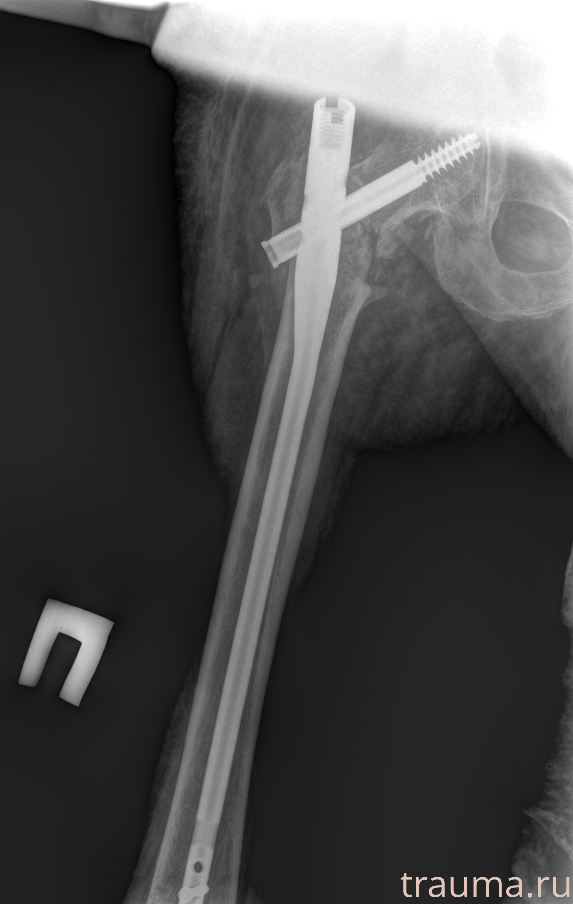 Рентген на дому: по вашему адресу приезжает врач-рентгенолог, травматолог-ортопед с мобильным рентгеновским аппаратом, проводит диагностику травмы или заболевания, делает необходимые рентгенограммы, дает рекомендации по дальнейшему лечению. Получить качественные снимки в домашних условиях возможно благодаря уникальной методике, разработанной МосРентген Центром для института  Склифосовского