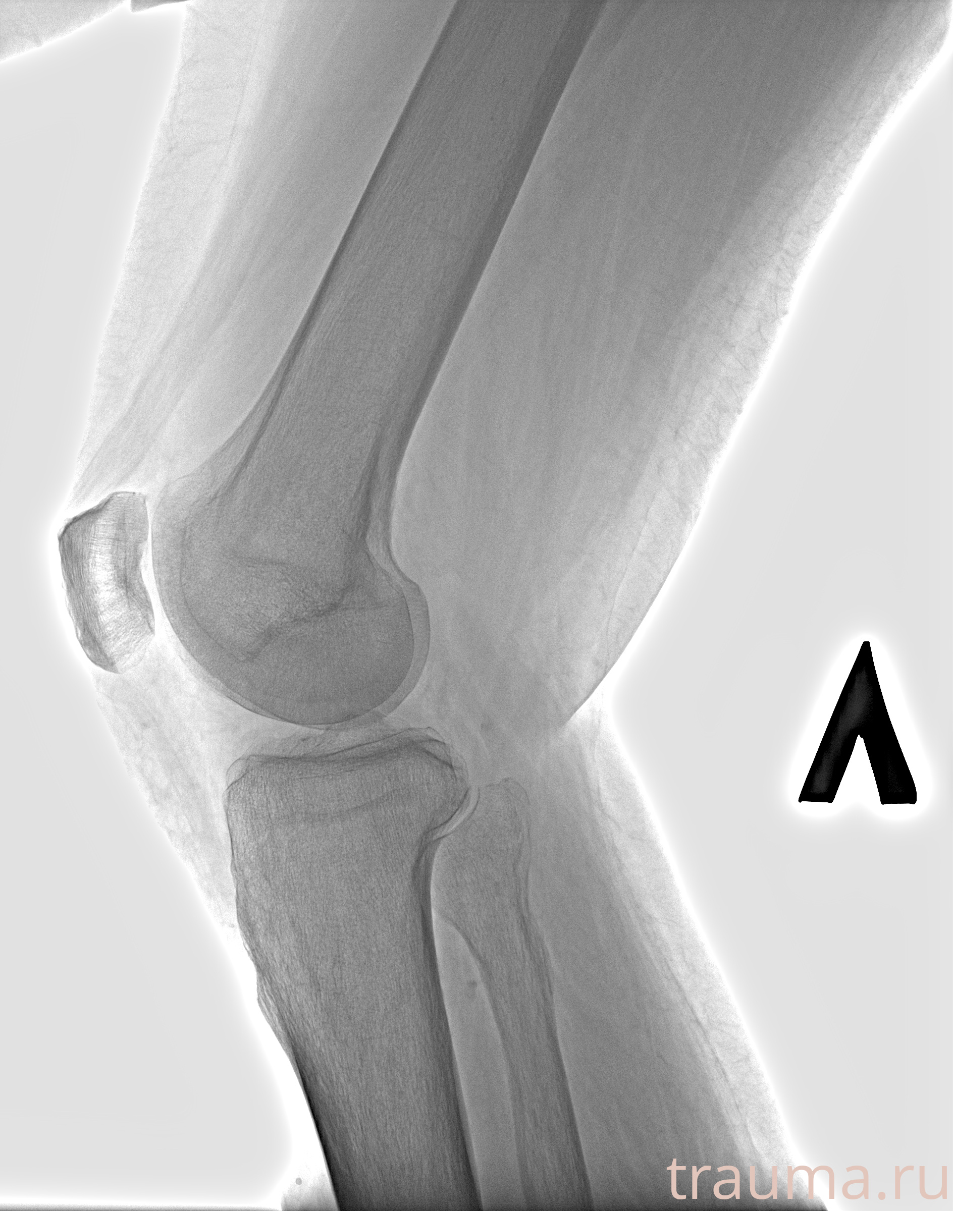 Рентген на дому: по вашему адресу приезжает врач-рентгенолог, травматолог-ортопед с мобильным рентгеновским аппаратом, проводит диагностику травмы или заболевания, делает необходимые рентгенограммы, дает рекомендации по дальнейшему лечению. Получить качественные снимки в домашних условиях возможно благодаря уникальной методике, разработанной МосРентген Центром для института  Склифосовского