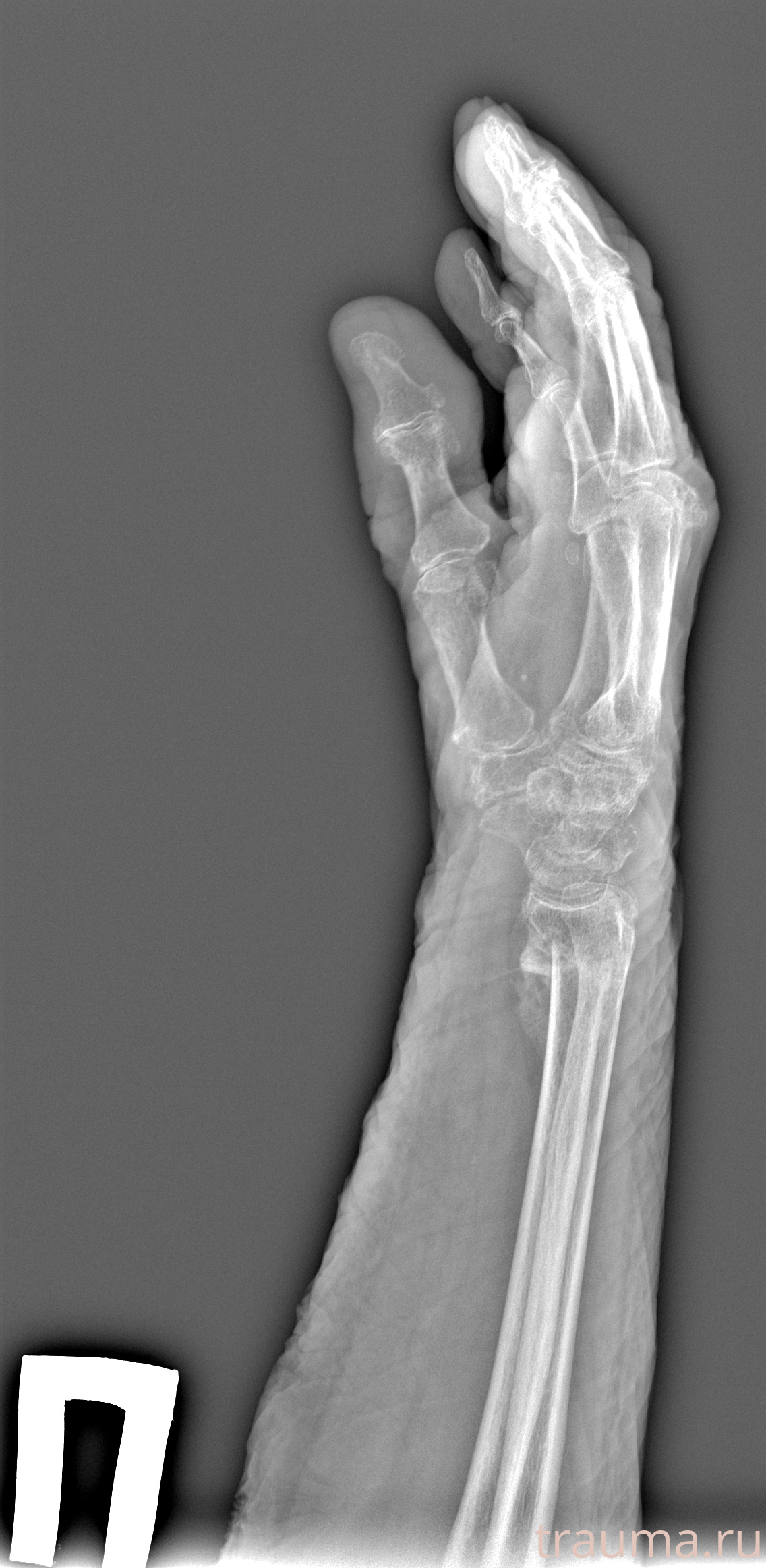 Рентген на дому: по вашему адресу приезжает врач-рентгенолог, травматолог-ортопед с мобильным рентгеновским аппаратом, проводит диагностику травмы или заболевания, делает необходимые рентгенограммы, дает рекомендации по дальнейшему лечению. Получить качественные снимки в домашних условиях возможно благодаря уникальной методике, разработанной МосРентген Центром для института  Склифосовского