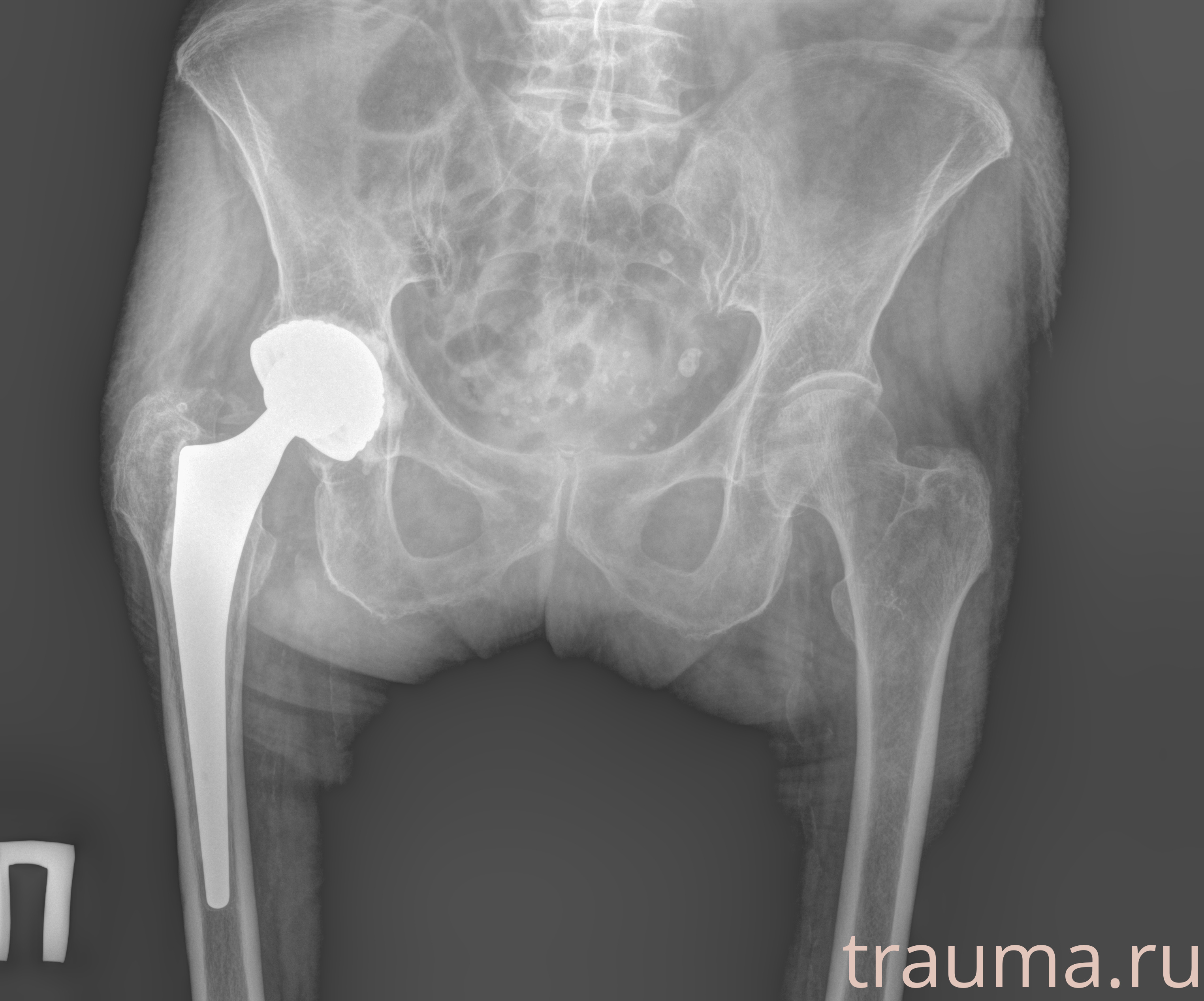 Рентген на дому: по вашему адресу приезжает врач-рентгенолог, травматолог-ортопед с мобильным рентгеновским аппаратом, проводит диагностику травмы или заболевания, делает необходимые рентгенограммы, дает рекомендации по дальнейшему лечению. Получить качественные снимки в домашних условиях возможно благодаря уникальной методике, разработанной МосРентген Центром для института  Склифосовского