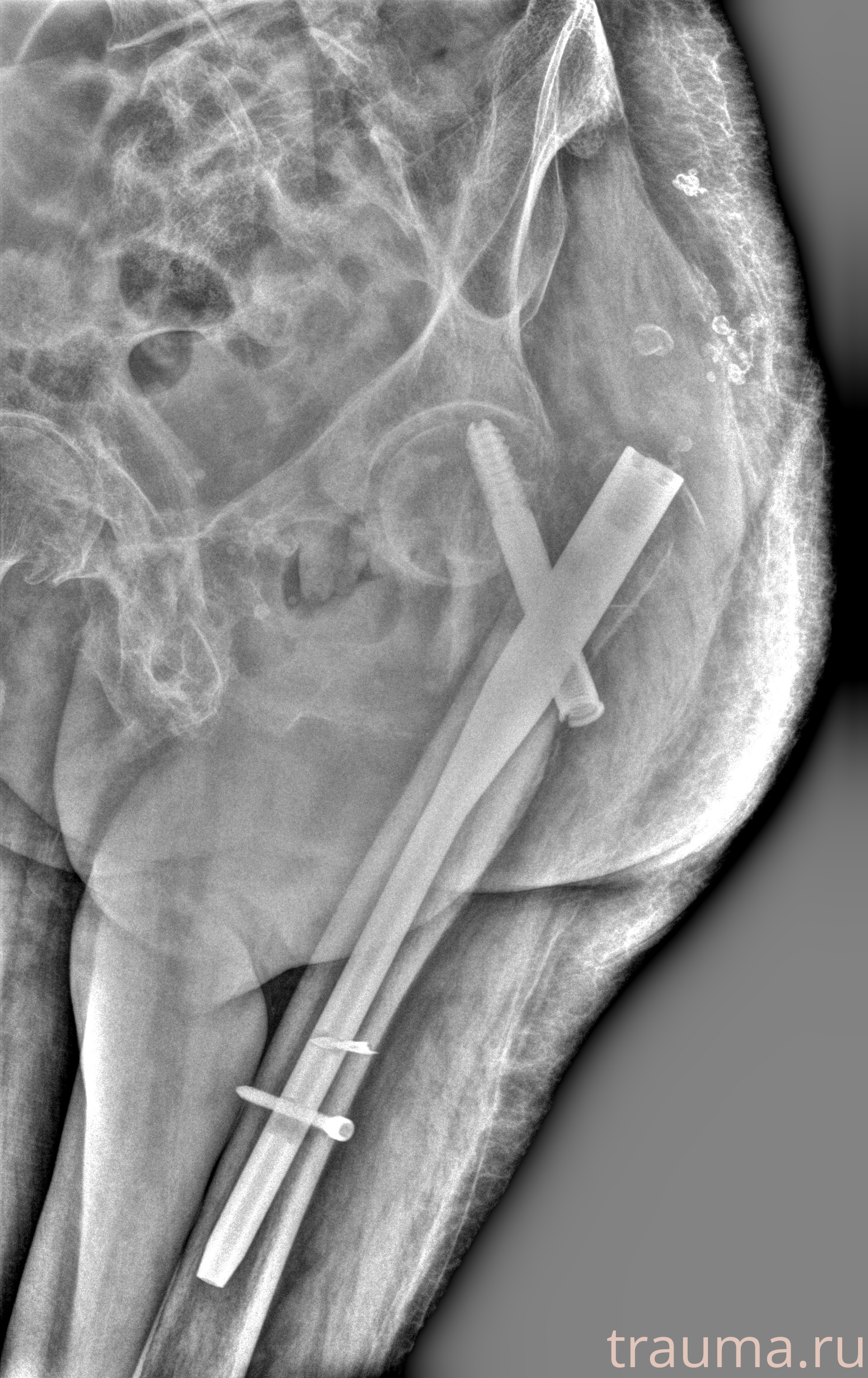 Рентген на дому: по вашему адресу приезжает врач-рентгенолог, травматолог-ортопед с мобильным рентгеновским аппаратом, проводит диагностику травмы или заболевания, делает необходимые рентгенограммы, дает рекомендации по дальнейшему лечению. Получить качественные снимки в домашних условиях возможно благодаря уникальной методике, разработанной МосРентген Центром для института  Склифосовского