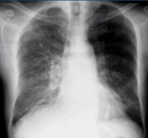 Антифибротическая терапия прогрессирующего фиброза легких