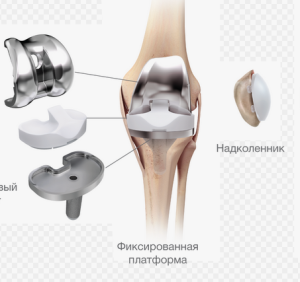 Влияние принципа персонализированного выравнивания на положение компонентов эндопротеза при тотальном эндопротезировании коленного сустава Влияние принципа персонализированного выравнивания на положение компонентов эндопротеза при тотальном эндопротезировании коленного сустава