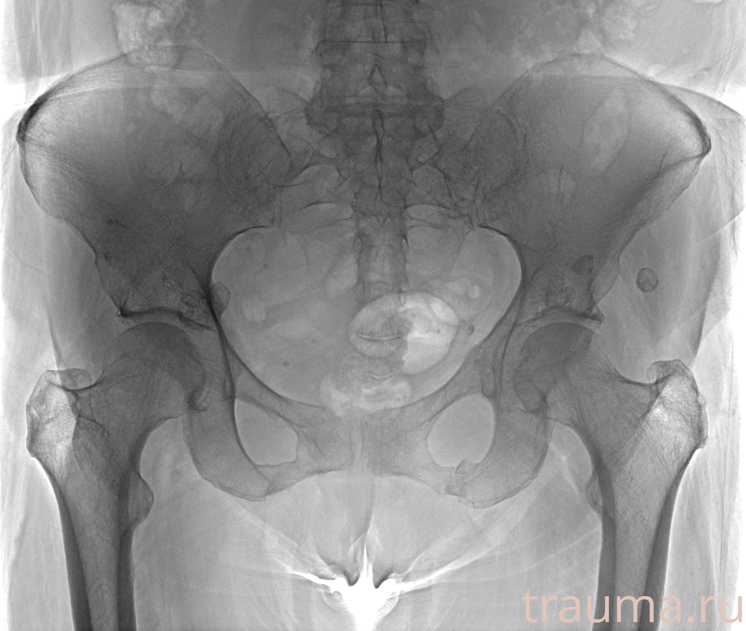 Рентген на дому: по вашему адресу приезжает врач-рентгенолог, травматолог-ортопед с мобильным рентгеновским аппаратом, проводит диагностику травмы или заболевания, делает необходимые рентгенограммы, дает рекомендации по дальнейшему лечению. Получить качественные снимки в домашних условиях возможно благодаря уникальной методике, разработанной МосРентген Центром для института  Склифосовского