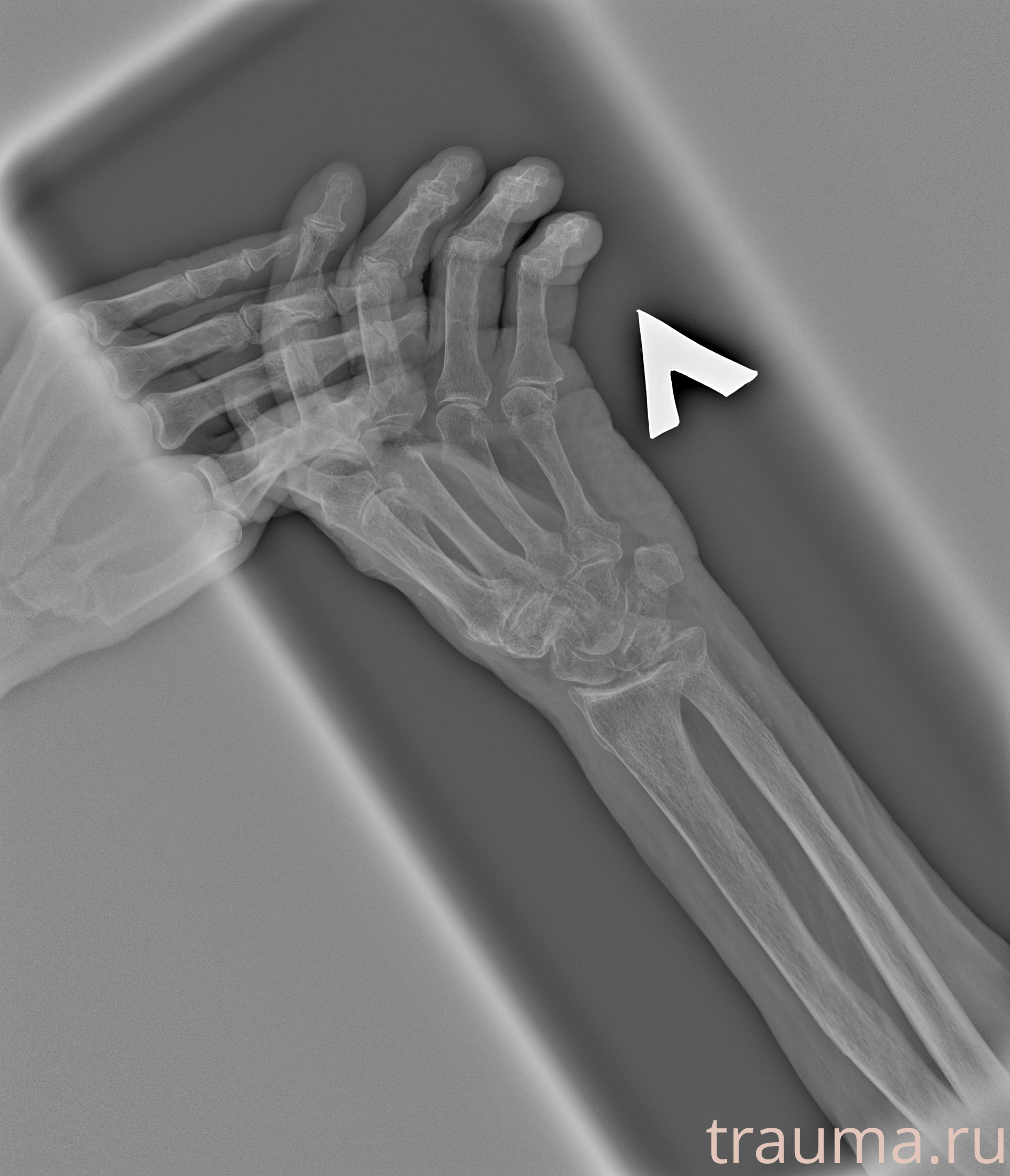 Рентген на дому: по вашему адресу приезжает врач-рентгенолог, травматолог-ортопед с мобильным рентгеновским аппаратом, проводит диагностику травмы или заболевания, делает необходимые рентгенограммы, дает рекомендации по дальнейшему лечению. Получить качественные снимки в домашних условиях возможно благодаря уникальной методике, разработанной МосРентген Центром для института  Склифосовского