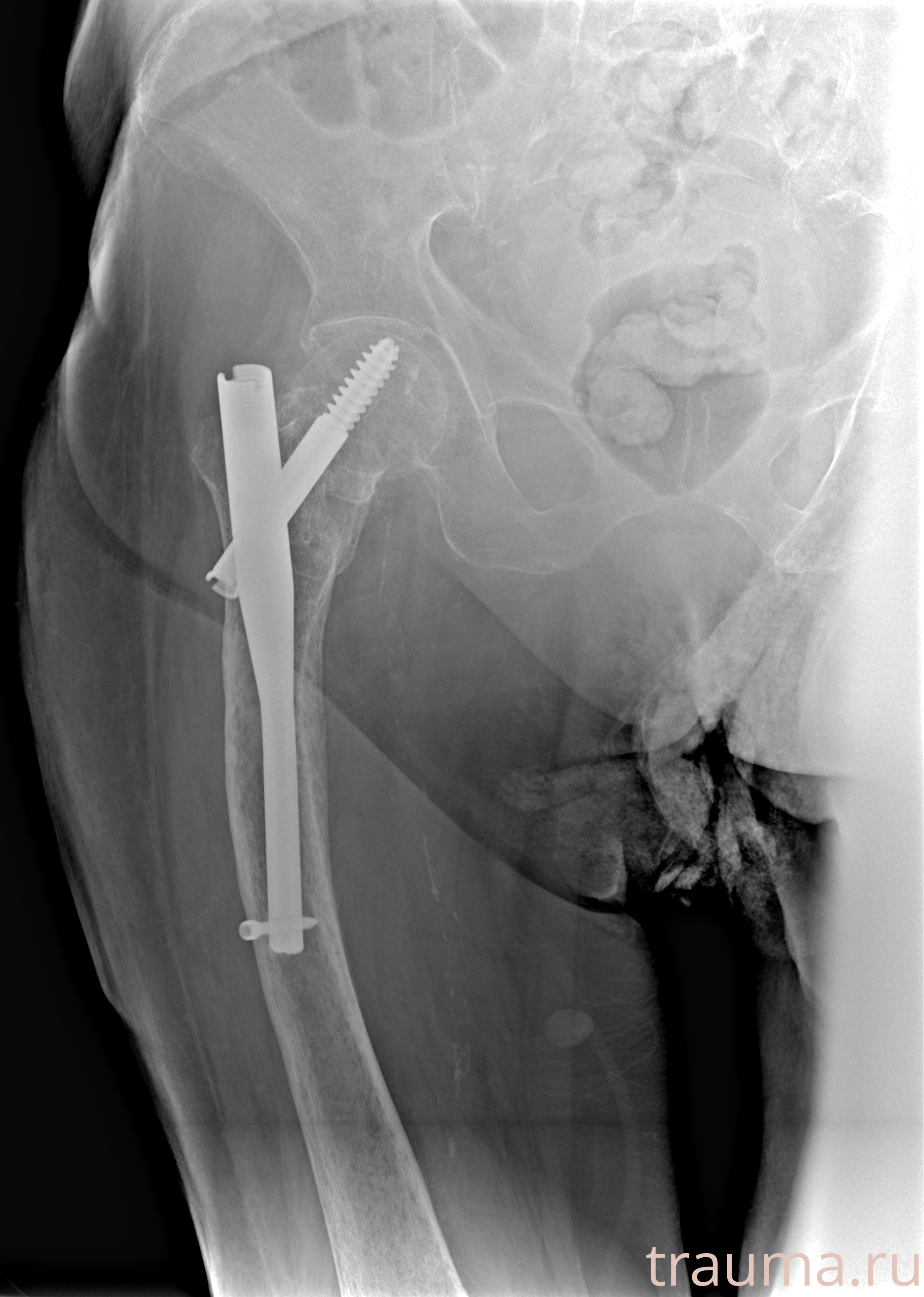 Рентген на дому: по вашему адресу приезжает врач-рентгенолог, травматолог-ортопед с мобильным рентгеновским аппаратом, проводит диагностику травмы или заболевания, делает необходимые рентгенограммы, дает рекомендации по дальнейшему лечению. Получить качественные снимки в домашних условиях возможно благодаря уникальной методике, разработанной МосРентген Центром для института  Склифосовского