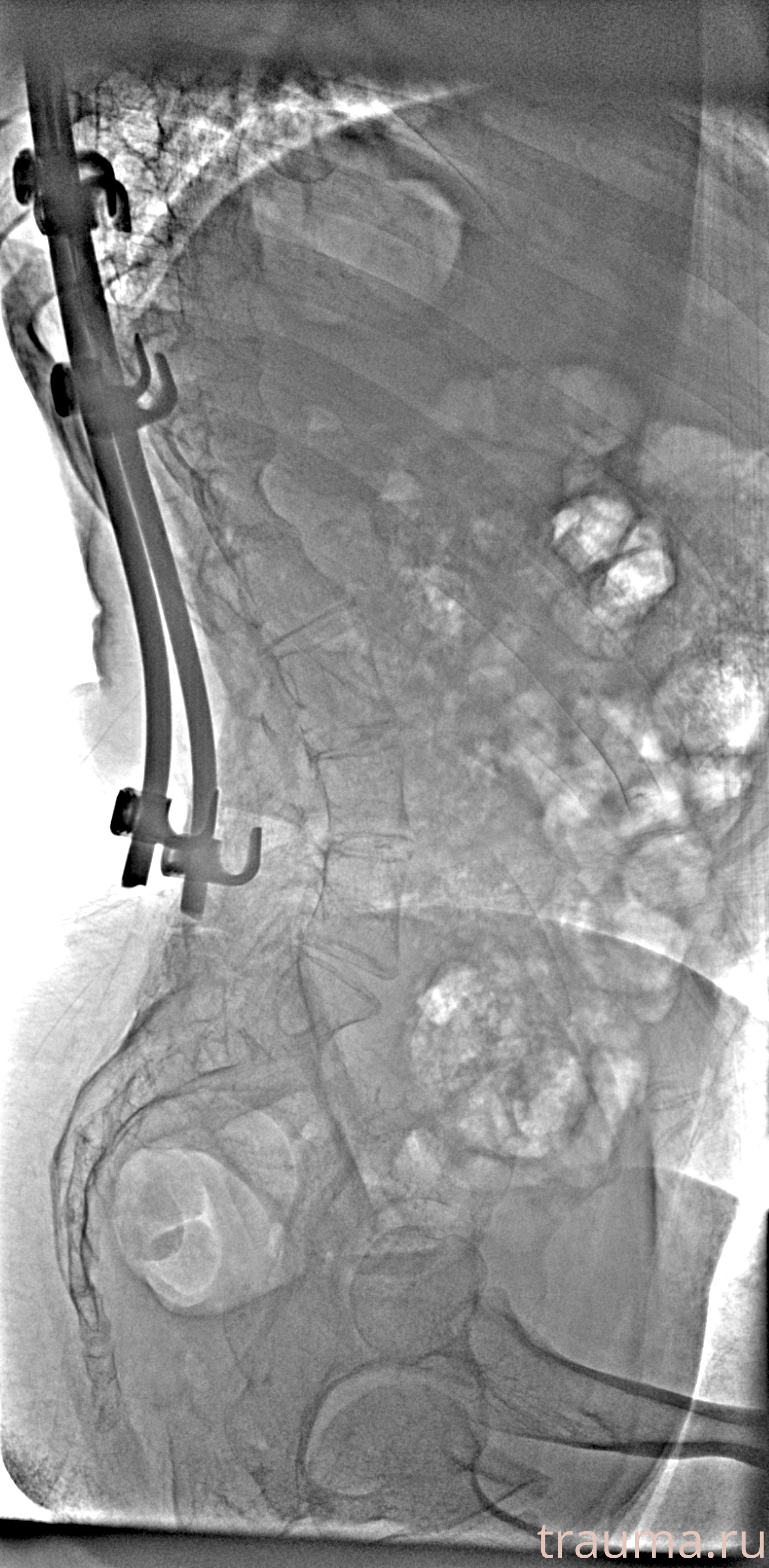 Рентген на дому: по вашему адресу приезжает врач-рентгенолог, травматолог-ортопед с мобильным рентгеновским аппаратом, проводит диагностику травмы или заболевания, делает необходимые рентгенограммы, дает рекомендации по дальнейшему лечению. Получить качественные снимки в домашних условиях возможно благодаря уникальной методике, разработанной МосРентген Центром для института  Склифосовского