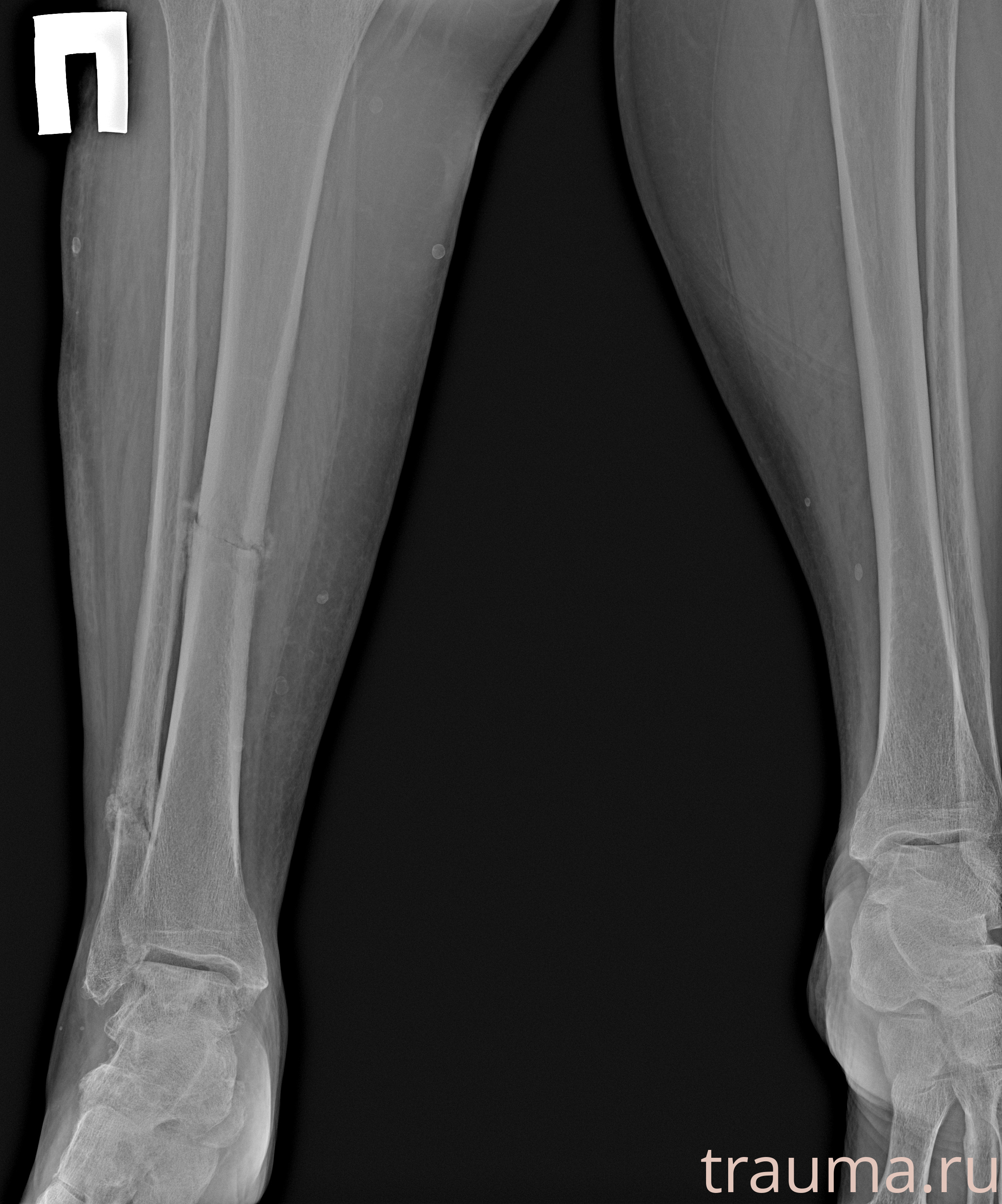 Рентген на дому: по вашему адресу приезжает врач-рентгенолог, травматолог-ортопед с мобильным рентгеновским аппаратом, проводит диагностику травмы или заболевания, делает необходимые рентгенограммы, дает рекомендации по дальнейшему лечению. Получить качественные снимки в домашних условиях возможно благодаря уникальной методике, разработанной МосРентген Центром для института  Склифосовского