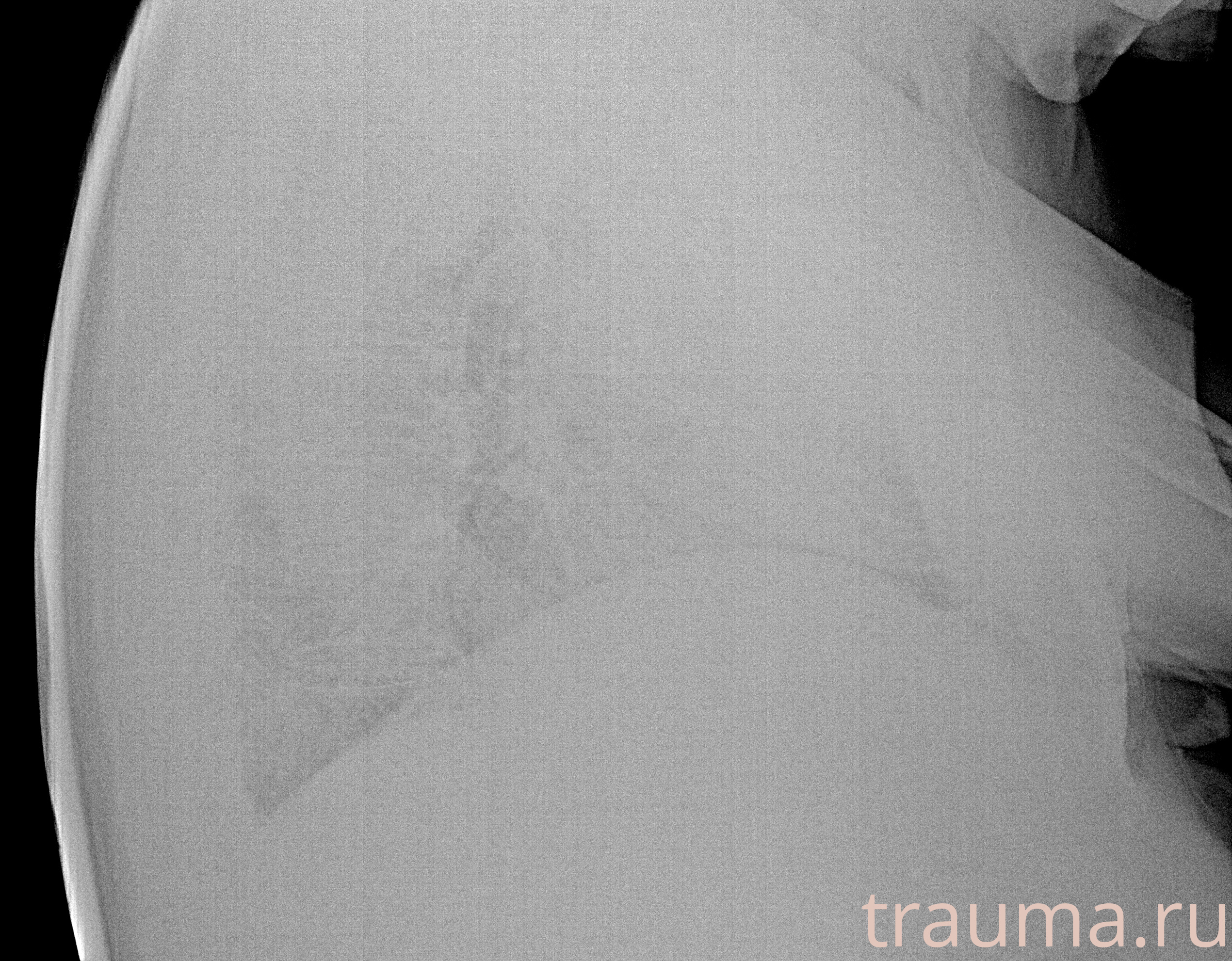 Рентген на дому: по вашему адресу приезжает врач-рентгенолог, травматолог-ортопед с мобильным рентгеновским аппаратом, проводит диагностику травмы или заболевания, делает необходимые рентгенограммы, дает рекомендации по дальнейшему лечению. Получить качественные снимки в домашних условиях возможно благодаря уникальной методике, разработанной МосРентген Центром для института  Склифосовского