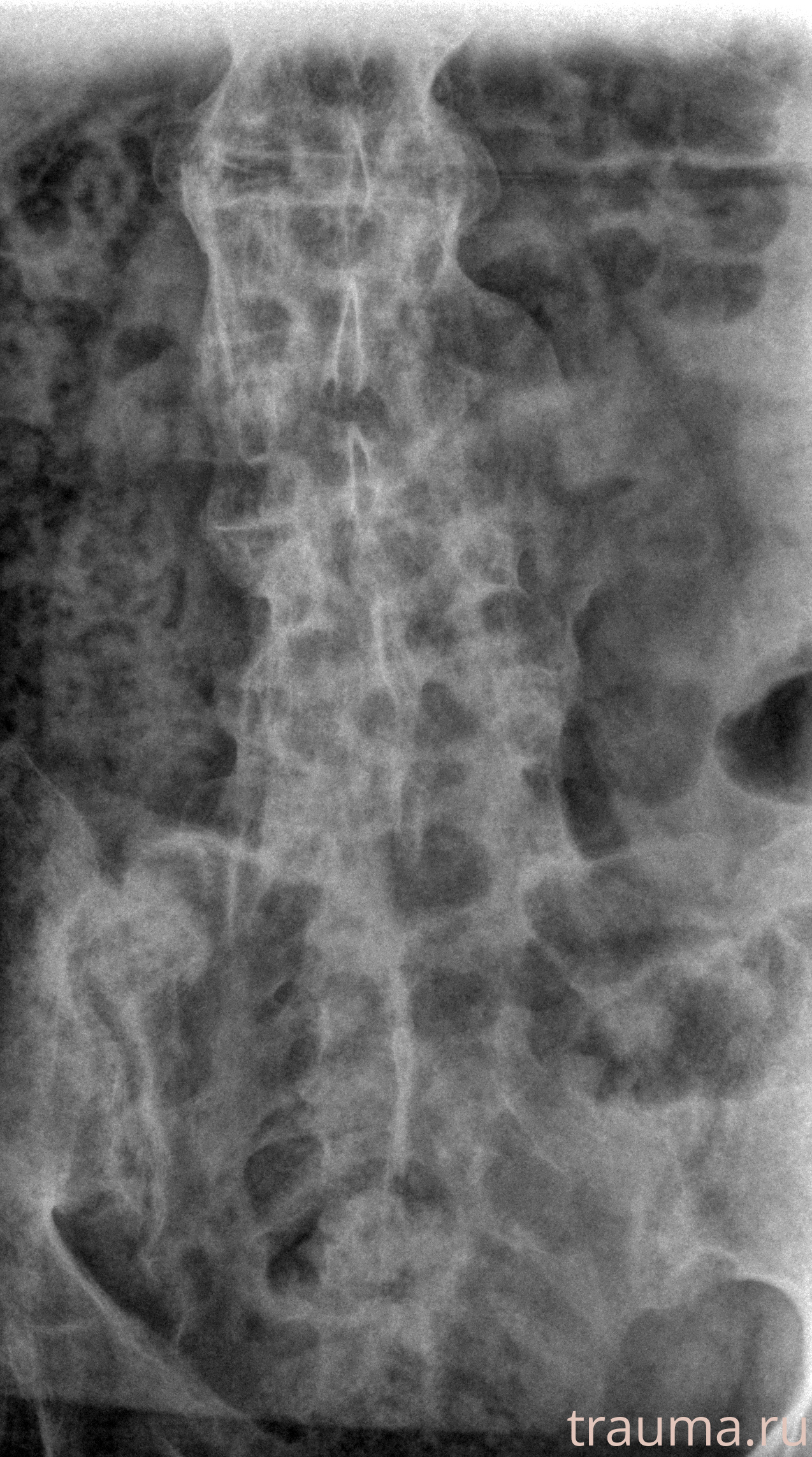 Рентген на дому: по вашему адресу приезжает врач-рентгенолог, травматолог-ортопед с мобильным рентгеновским аппаратом, проводит диагностику травмы или заболевания, делает необходимые рентгенограммы, дает рекомендации по дальнейшему лечению. Получить качественные снимки в домашних условиях возможно благодаря уникальной методике, разработанной МосРентген Центром для института  Склифосовского