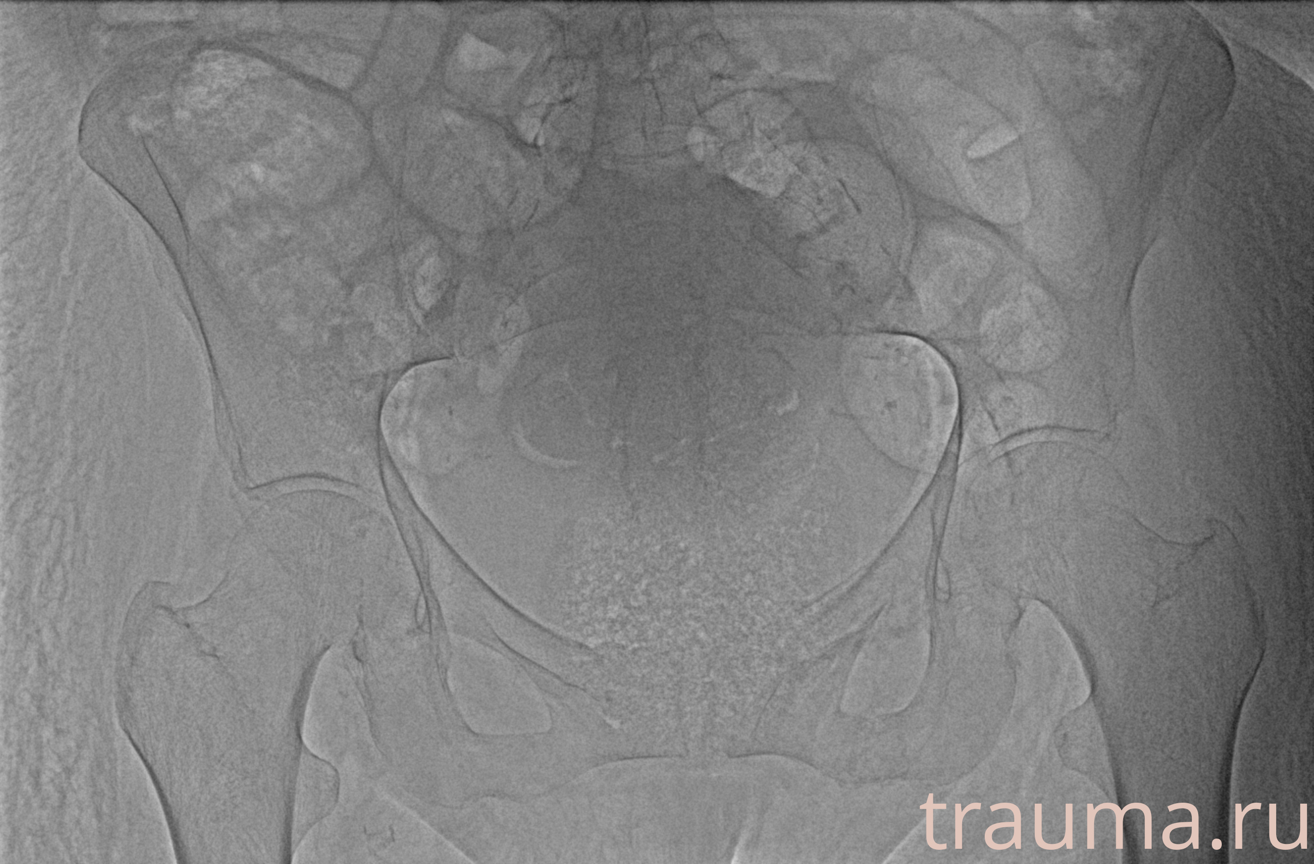 Рентген на дому: по вашему адресу приезжает врач-рентгенолог, травматолог-ортопед с мобильным рентгеновским аппаратом, проводит диагностику травмы или заболевания, делает необходимые рентгенограммы, дает рекомендации по дальнейшему лечению. Получить качественные снимки в домашних условиях возможно благодаря уникальной методике, разработанной МосРентген Центром для института  Склифосовского