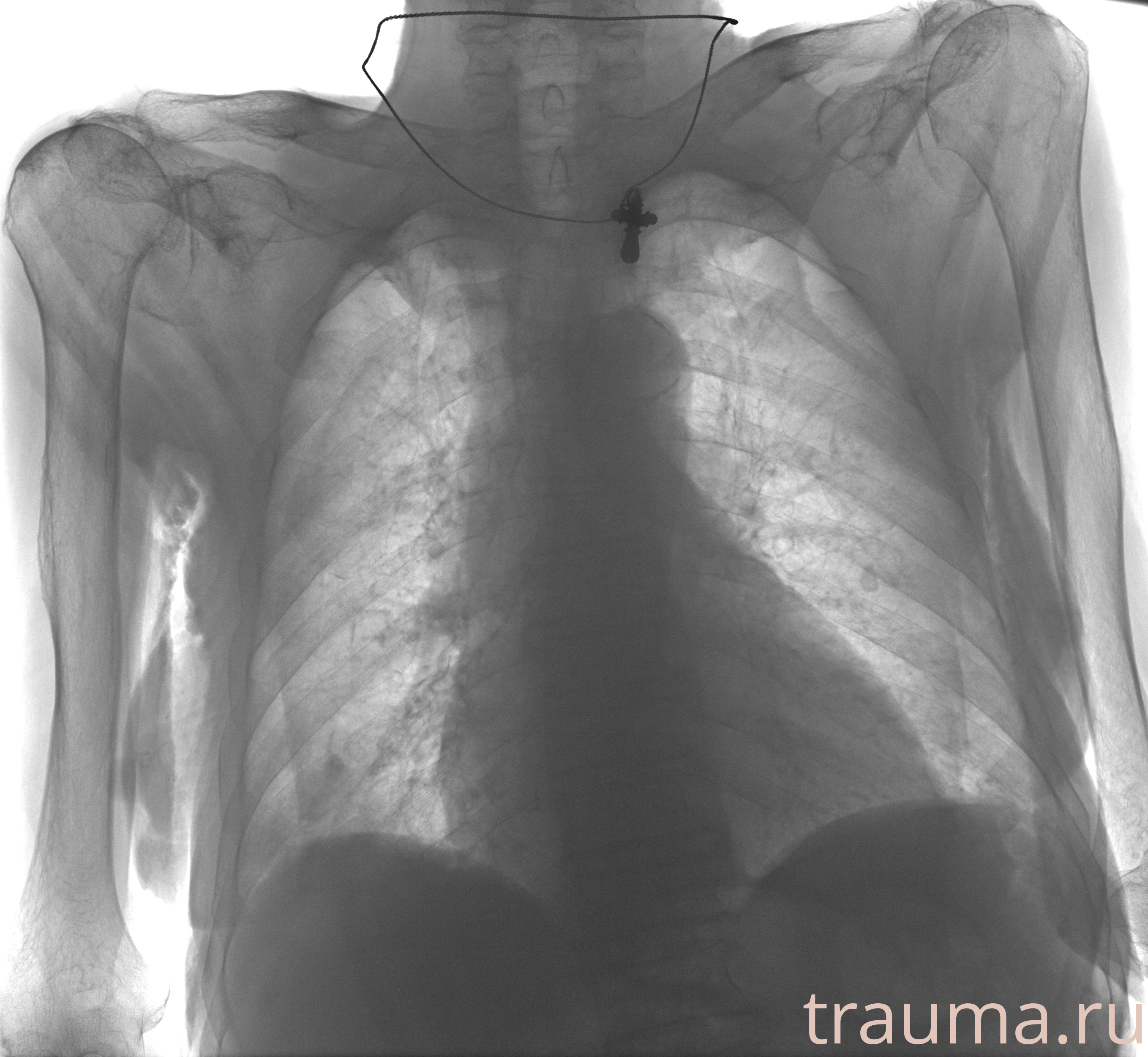 Рентген на дому: по вашему адресу приезжает врач-рентгенолог, травматолог-ортопед с мобильным рентгеновским аппаратом, проводит диагностику травмы или заболевания, делает необходимые рентгенограммы, дает рекомендации по дальнейшему лечению. Получить качественные снимки в домашних условиях возможно благодаря уникальной методике, разработанной МосРентген Центром для института  Склифосовского