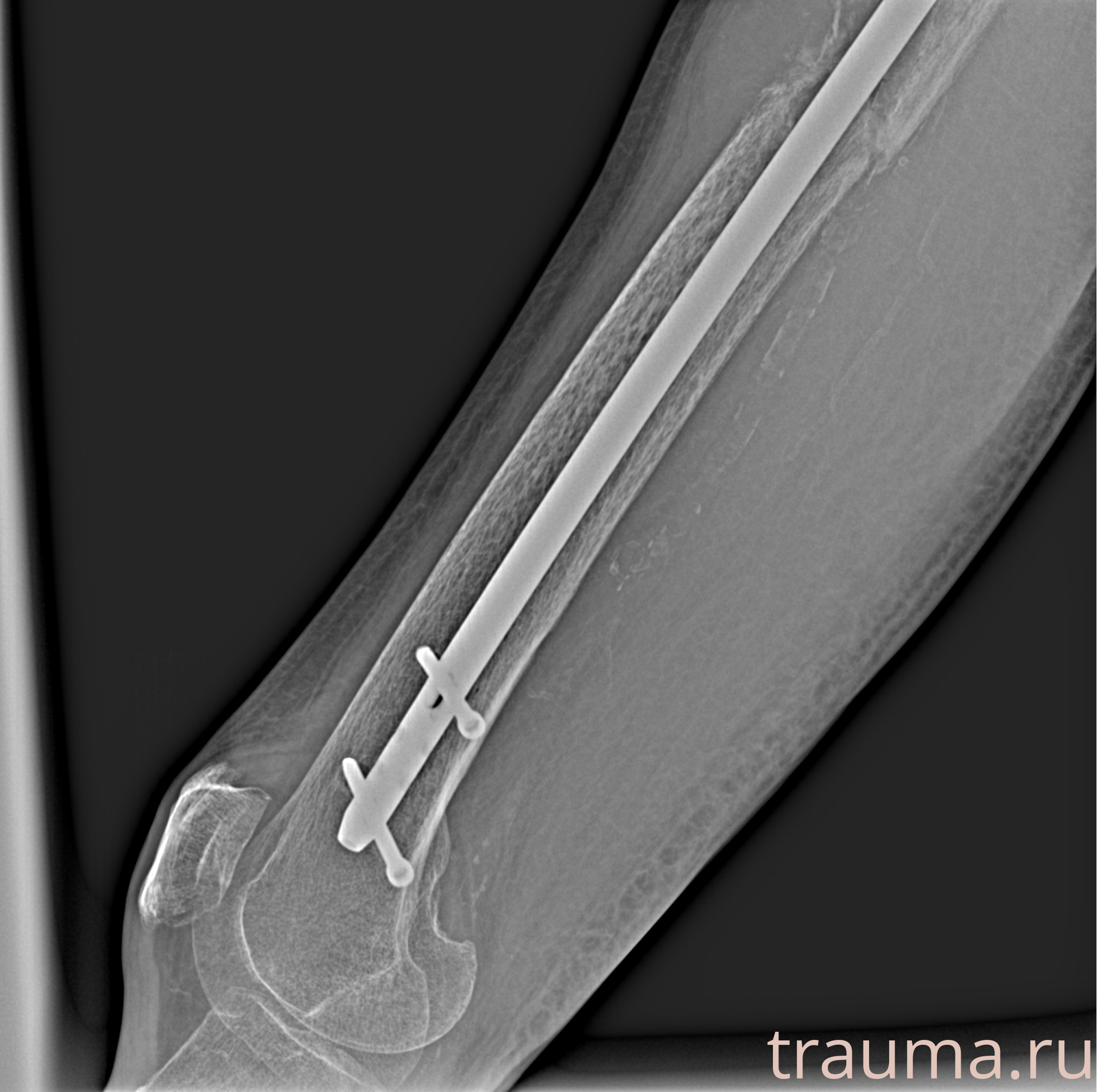 Рентген на дому: по вашему адресу приезжает врач-рентгенолог, травматолог-ортопед с мобильным рентгеновским аппаратом, проводит диагностику травмы или заболевания, делает необходимые рентгенограммы, дает рекомендации по дальнейшему лечению. Получить качественные снимки в домашних условиях возможно благодаря уникальной методике, разработанной МосРентген Центром для института  Склифосовского