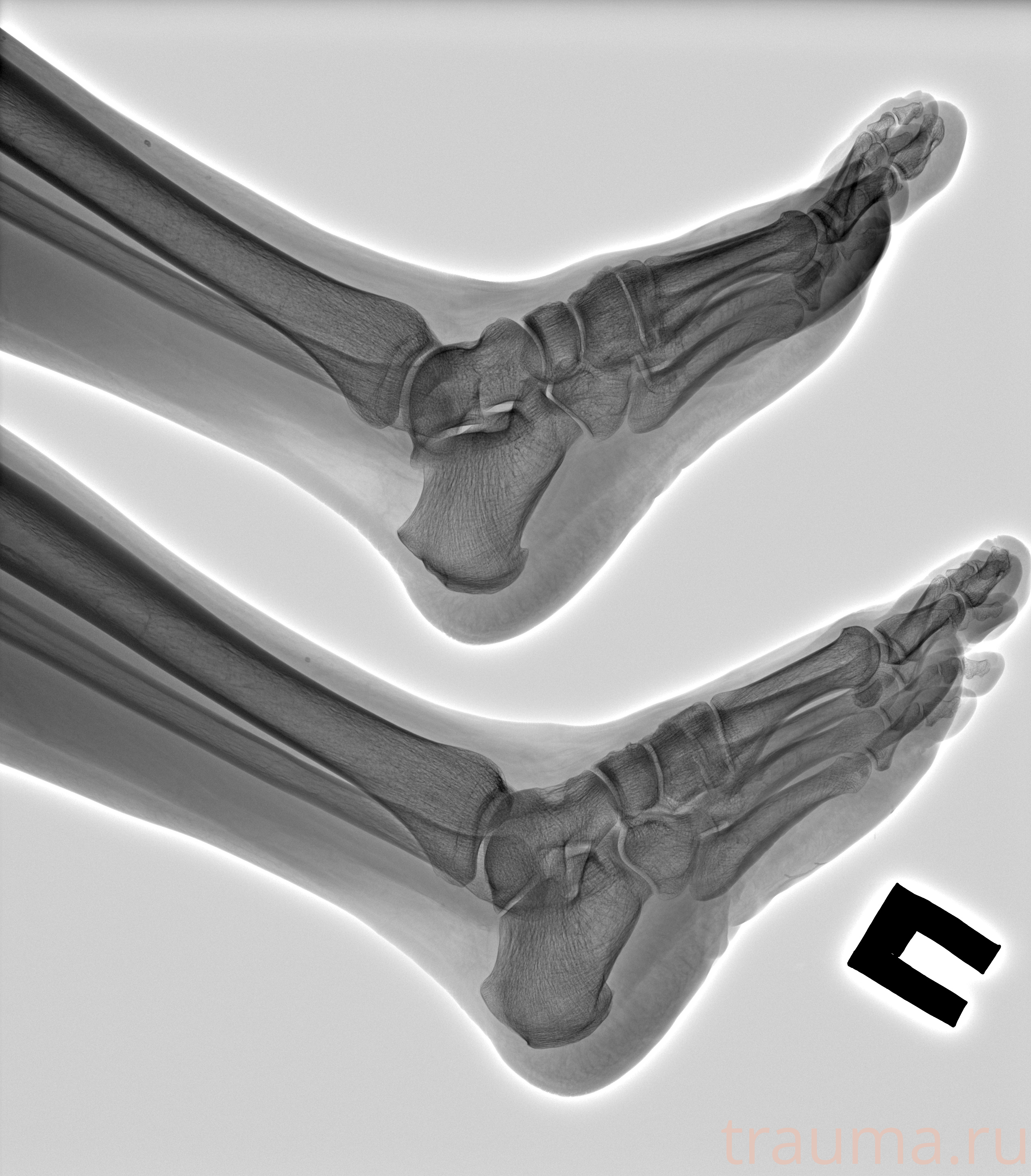 Рентген на дому: по вашему адресу приезжает врач-рентгенолог, травматолог-ортопед с мобильным рентгеновским аппаратом, проводит диагностику травмы или заболевания, делает необходимые рентгенограммы, дает рекомендации по дальнейшему лечению. Получить качественные снимки в домашних условиях возможно благодаря уникальной методике, разработанной МосРентген Центром для института  Склифосовского