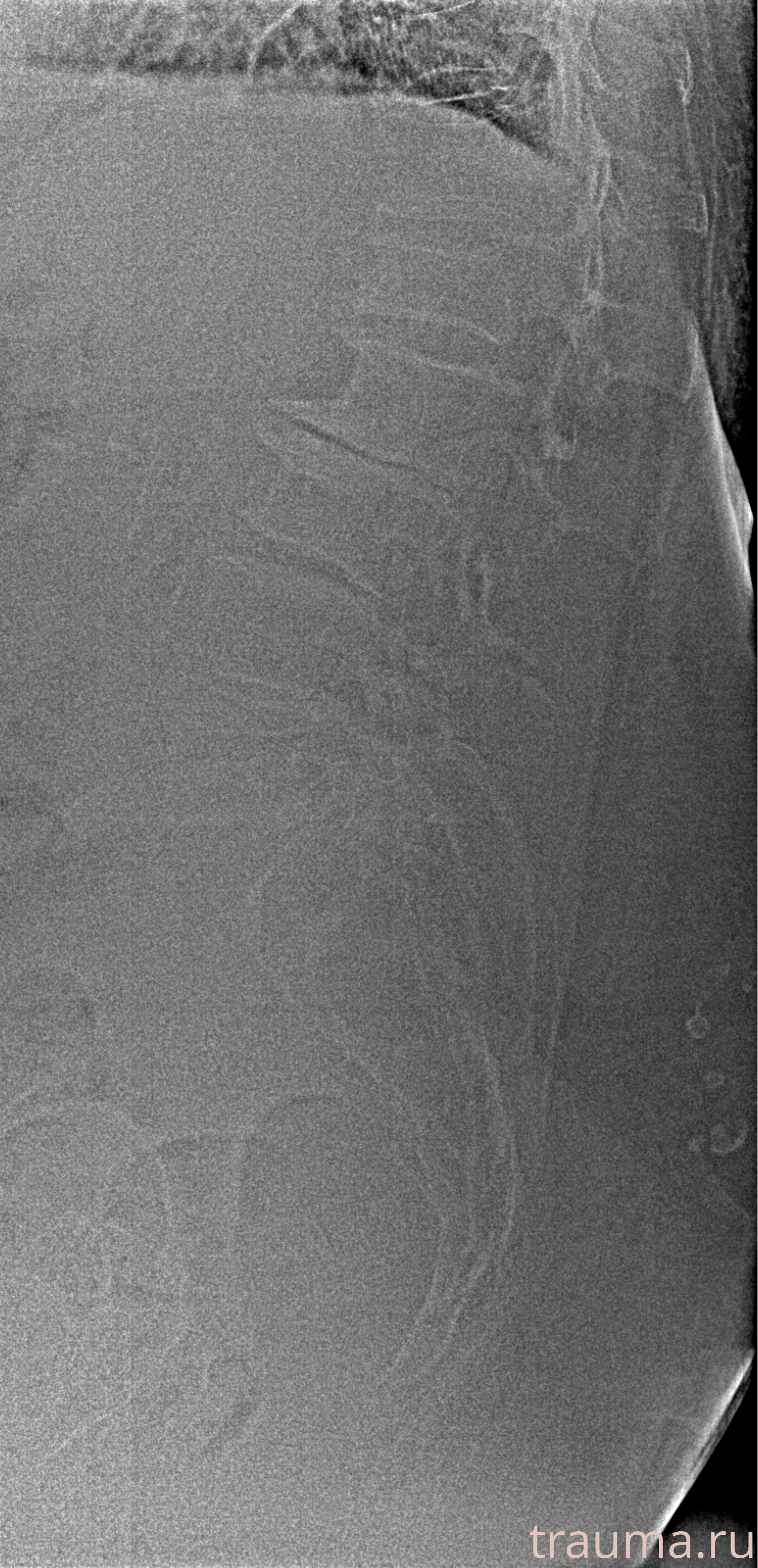 Рентген на дому: по вашему адресу приезжает врач-рентгенолог, травматолог-ортопед с мобильным рентгеновским аппаратом, проводит диагностику травмы или заболевания, делает необходимые рентгенограммы, дает рекомендации по дальнейшему лечению. Получить качественные снимки в домашних условиях возможно благодаря уникальной методике, разработанной МосРентген Центром для института  Склифосовского