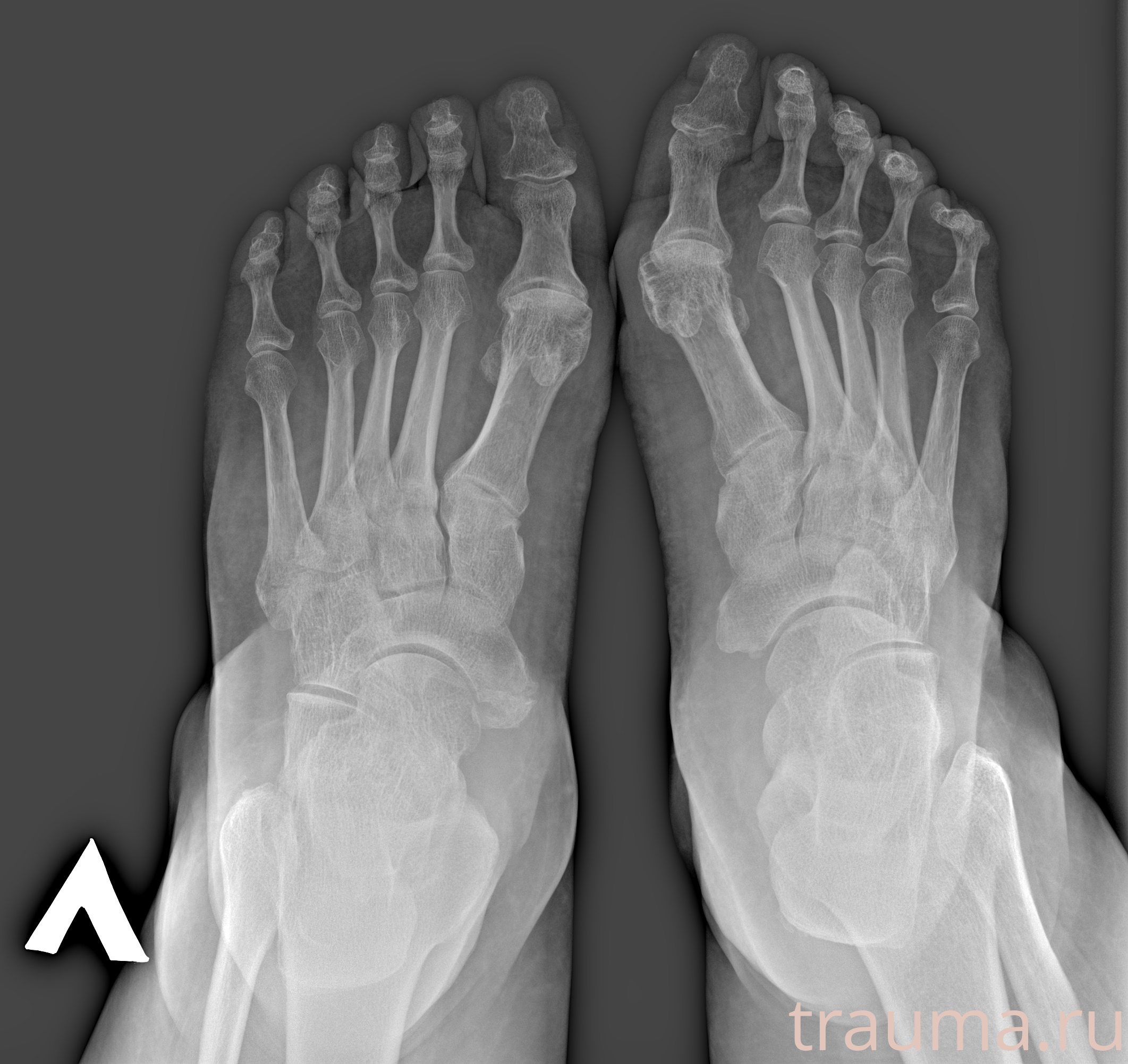 Рентген на дому: по вашему адресу приезжает врач-рентгенолог, травматолог-ортопед с мобильным рентгеновским аппаратом, проводит диагностику травмы или заболевания, делает необходимые рентгенограммы, дает рекомендации по дальнейшему лечению. Получить качественные снимки в домашних условиях возможно благодаря уникальной методике, разработанной МосРентген Центром для института  Склифосовского