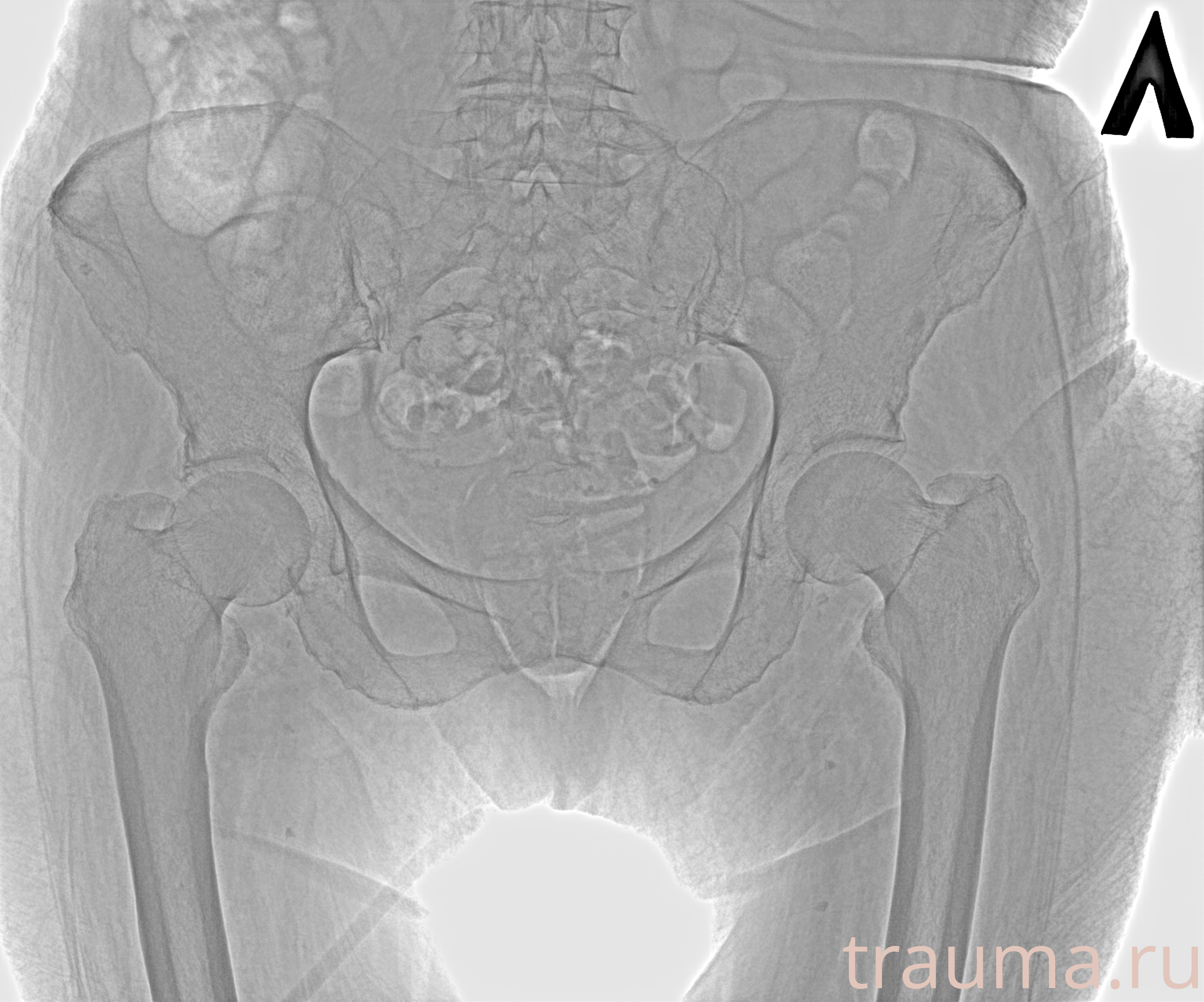 Рентген на дому: по вашему адресу приезжает врач-рентгенолог, травматолог-ортопед с мобильным рентгеновским аппаратом, проводит диагностику травмы или заболевания, делает необходимые рентгенограммы, дает рекомендации по дальнейшему лечению. Получить качественные снимки в домашних условиях возможно благодаря уникальной методике, разработанной МосРентген Центром для института  Склифосовского