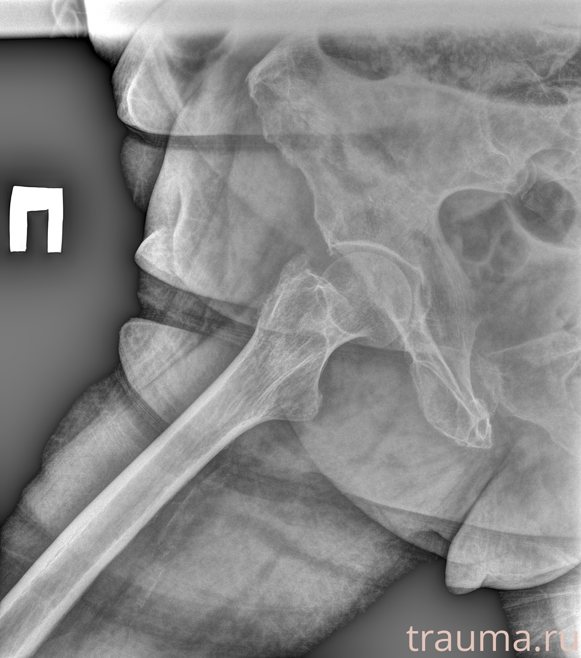 Рентген на дому: по вашему адресу приезжает врач-рентгенолог, травматолог-ортопед с мобильным рентгеновским аппаратом, проводит диагностику травмы или заболевания, делает необходимые рентгенограммы, дает рекомендации по дальнейшему лечению. Получить качественные снимки в домашних условиях возможно благодаря уникальной методике, разработанной МосРентген Центром для института  Склифосовского