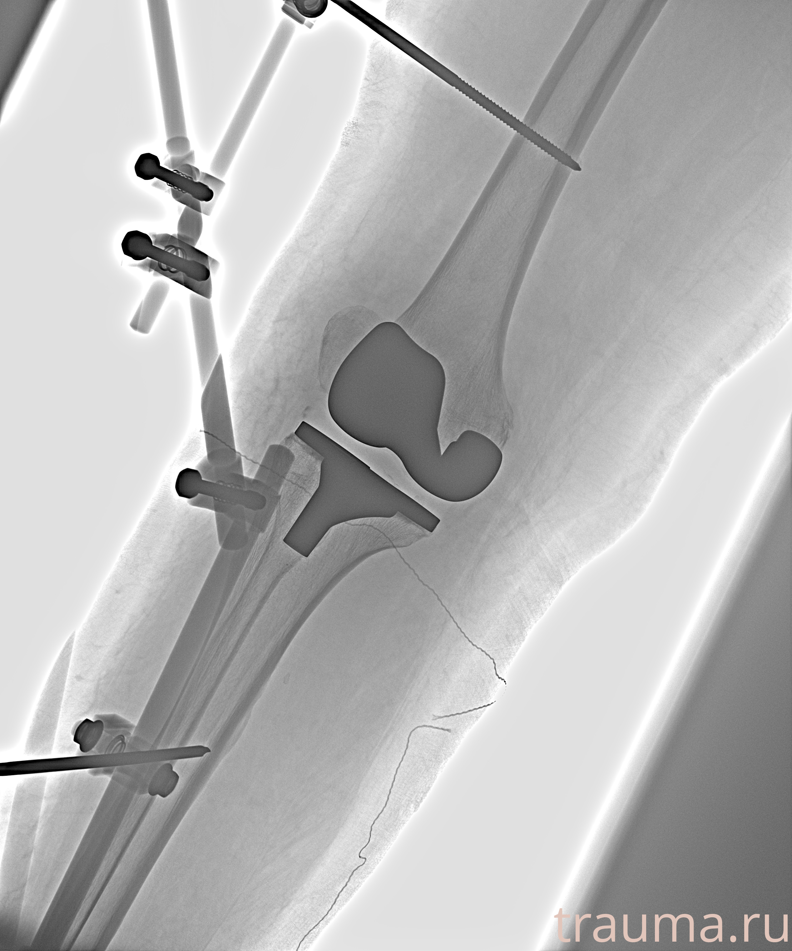 Рентген на дому: по вашему адресу приезжает врач-рентгенолог, травматолог-ортопед с мобильным рентгеновским аппаратом, проводит диагностику травмы или заболевания, делает необходимые рентгенограммы, дает рекомендации по дальнейшему лечению. Получить качественные снимки в домашних условиях возможно благодаря уникальной методике, разработанной МосРентген Центром для института  Склифосовского