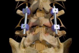 Оперативное лечение спондилолистеза позвонка l5 с применением транспедикулярных фиксаторов