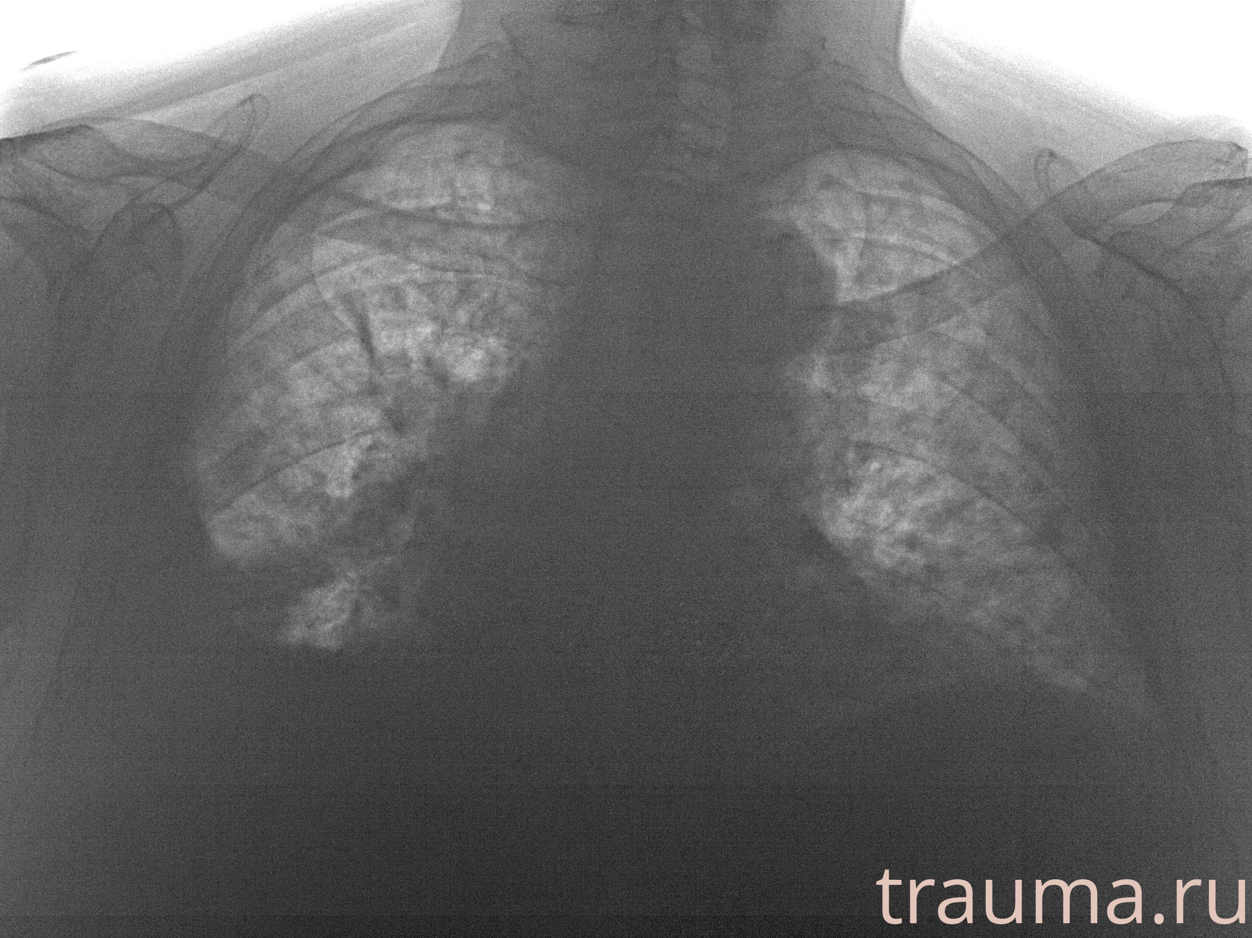 Рентген на дому: по вашему адресу приезжает врач-рентгенолог, травматолог-ортопед с мобильным рентгеновским аппаратом, проводит диагностику травмы или заболевания, делает необходимые рентгенограммы, дает рекомендации по дальнейшему лечению. Получить качественные снимки в домашних условиях возможно благодаря уникальной методике, разработанной МосРентген Центром для института  Склифосовского