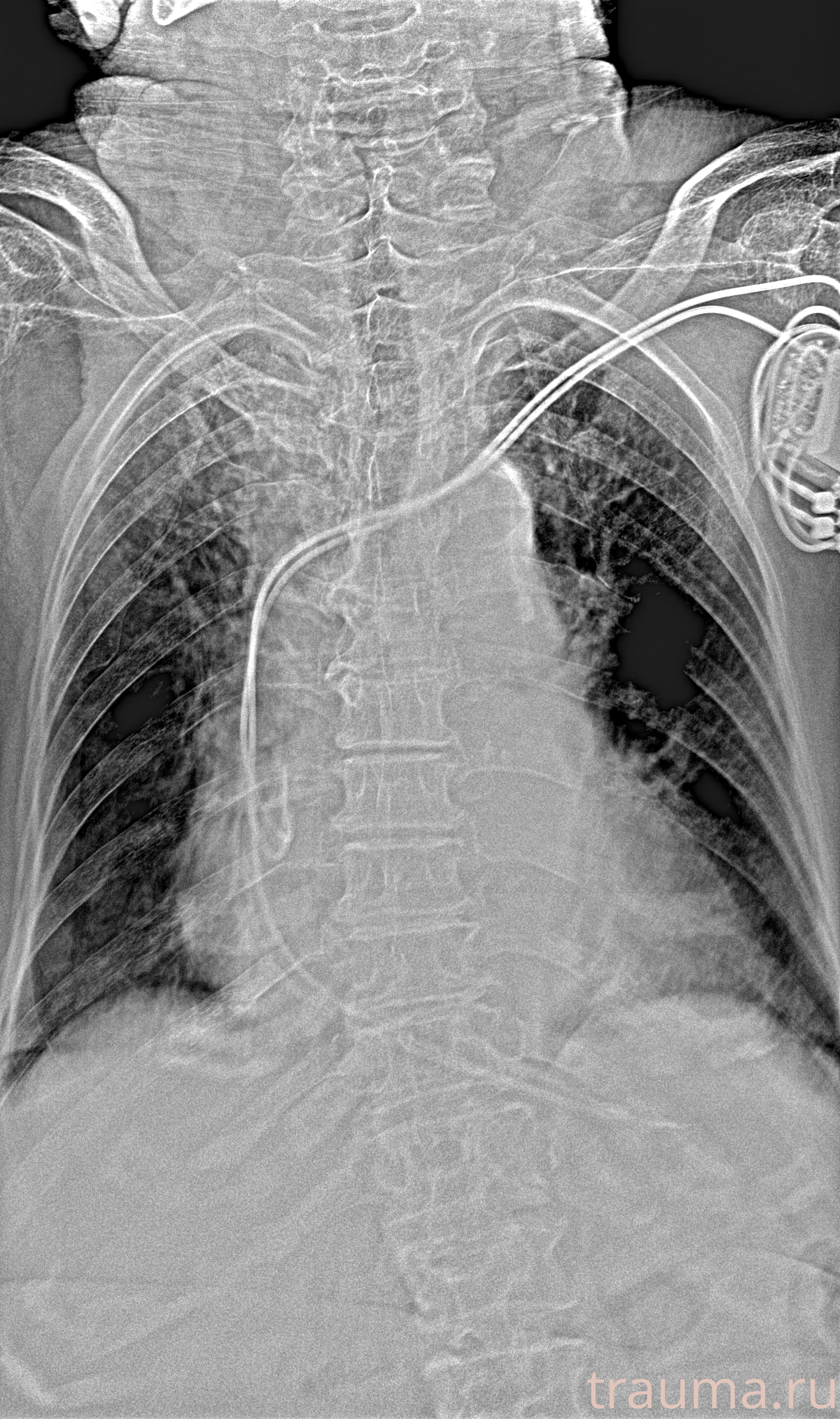 Рентген на дому: по вашему адресу приезжает врач-рентгенолог, травматолог-ортопед с мобильным рентгеновским аппаратом, проводит диагностику травмы или заболевания, делает необходимые рентгенограммы, дает рекомендации по дальнейшему лечению. Получить качественные снимки в домашних условиях возможно благодаря уникальной методике, разработанной МосРентген Центром для института  Склифосовского