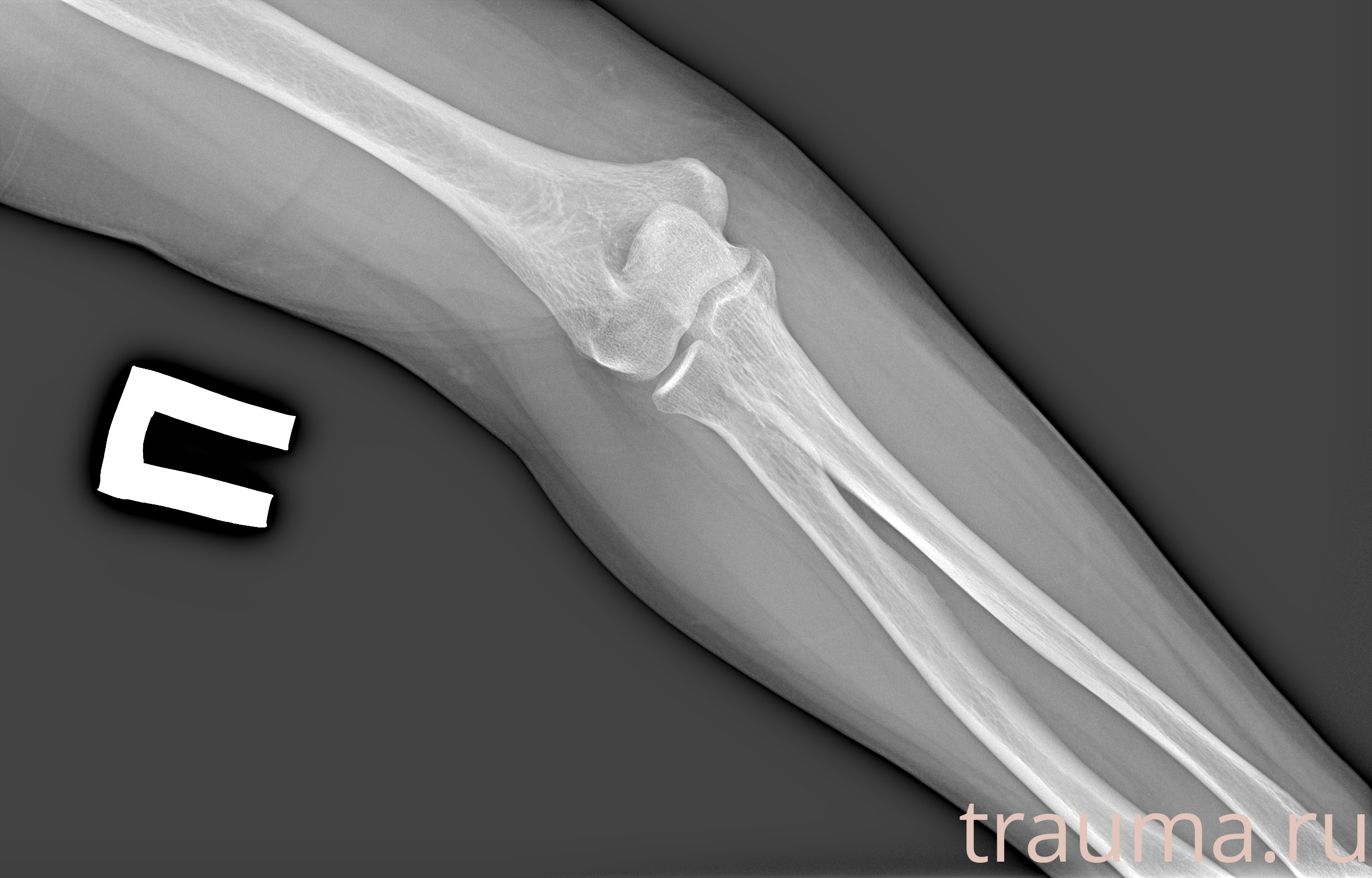 Рентген на дому: по вашему адресу приезжает врач-рентгенолог, травматолог-ортопед с мобильным рентгеновским аппаратом, проводит диагностику травмы или заболевания, делает необходимые рентгенограммы, дает рекомендации по дальнейшему лечению. Получить качественные снимки в домашних условиях возможно благодаря уникальной методике, разработанной МосРентген Центром для института  Склифосовского