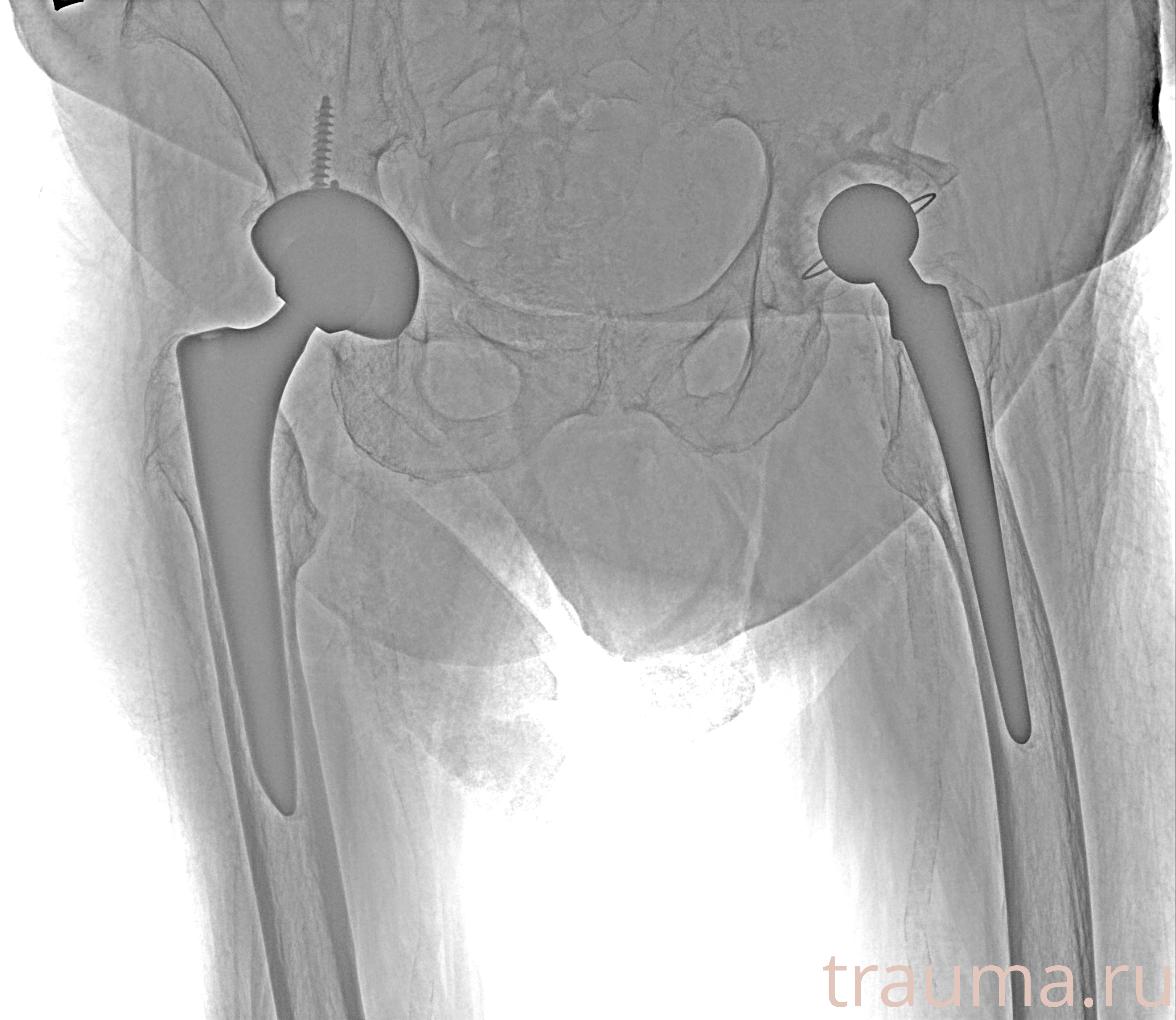 Рентген на дому: по вашему адресу приезжает врач-рентгенолог, травматолог-ортопед с мобильным рентгеновским аппаратом, проводит диагностику травмы или заболевания, делает необходимые рентгенограммы, дает рекомендации по дальнейшему лечению. Получить качественные снимки в домашних условиях возможно благодаря уникальной методике, разработанной МосРентген Центром для института  Склифосовского