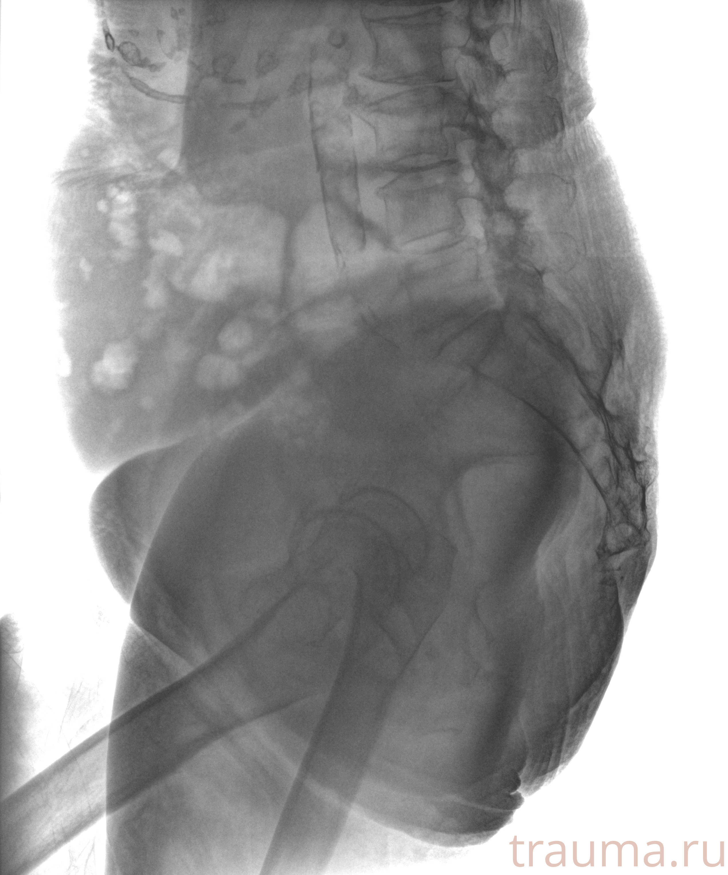 Рентген на дому: по вашему адресу приезжает врач-рентгенолог, травматолог-ортопед с мобильным рентгеновским аппаратом, проводит диагностику травмы или заболевания, делает необходимые рентгенограммы, дает рекомендации по дальнейшему лечению. Получить качественные снимки в домашних условиях возможно благодаря уникальной методике, разработанной МосРентген Центром для института  Склифосовского